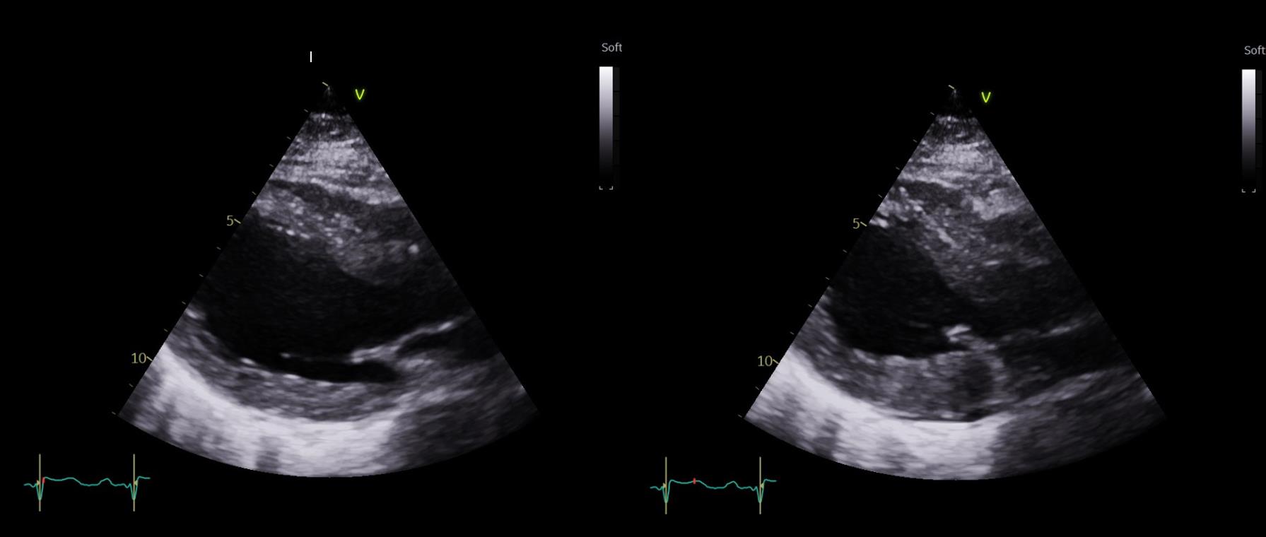 Echocardiogram showing apical ballooning and dilation, with basal segment contraction.