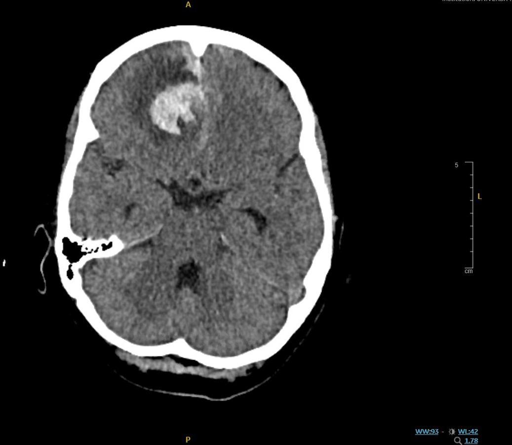Computed tomography head showing bilateral subarachnoid hemorrhage, and right frontal lobe Intracranial hemorrhage.