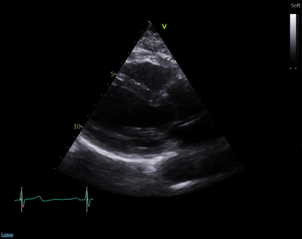 Echocardiogram showing resolution of left ventricular function with some degree of left ventricular hypertrophy.