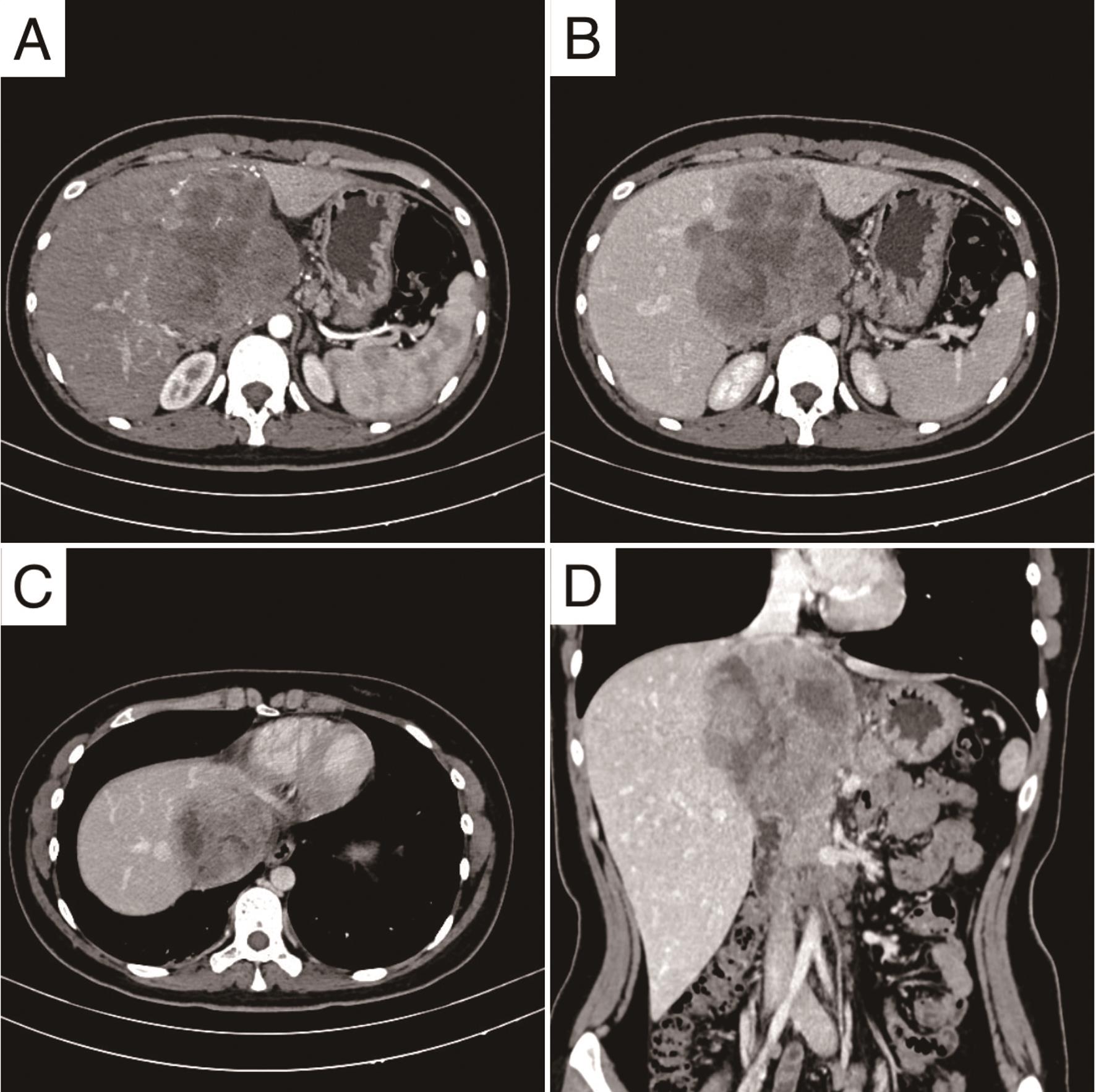 Contrast-enhanced CT scans of the hepatic ES.