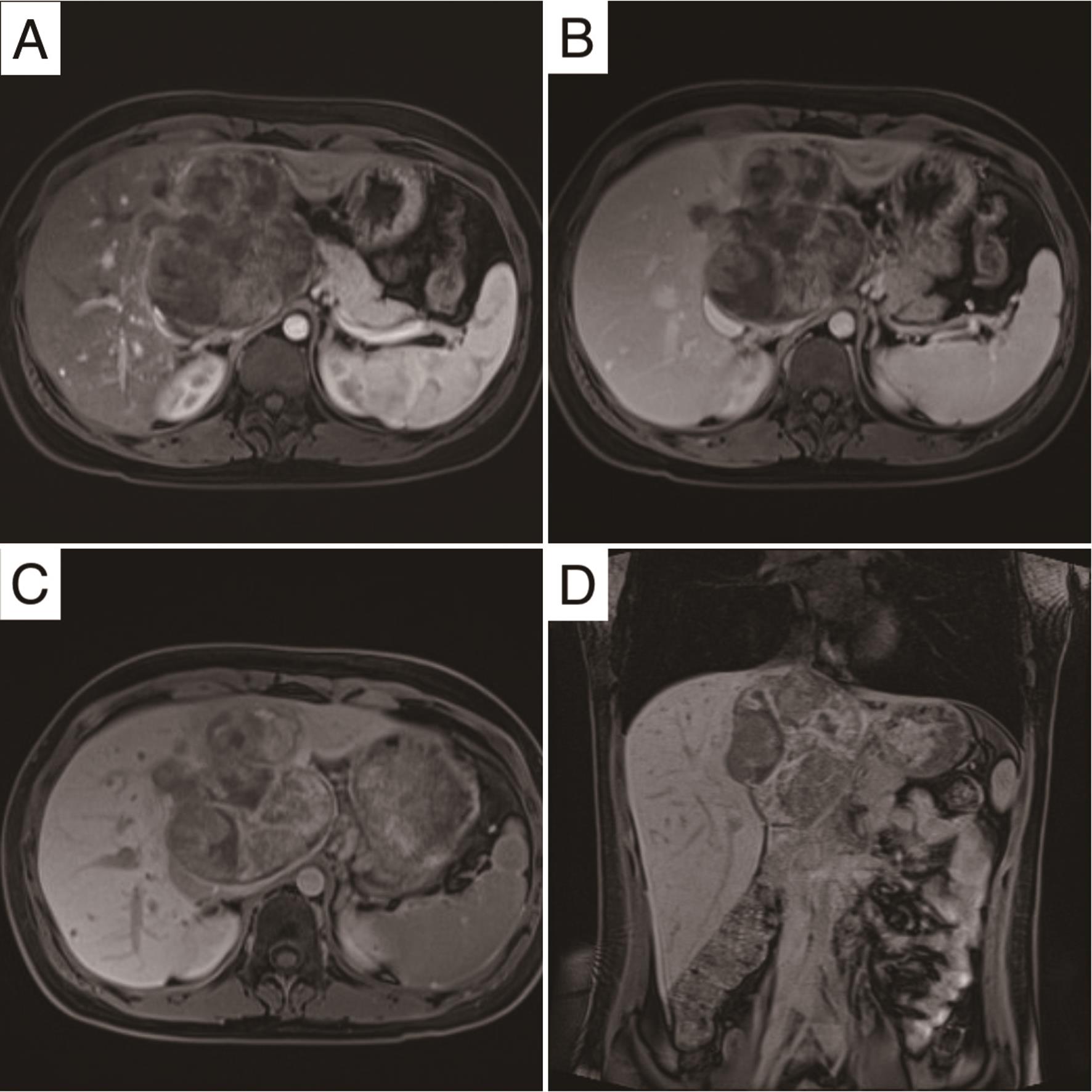 Gadobenate dimeglumine-enhanced MRI of the hepatic ES.