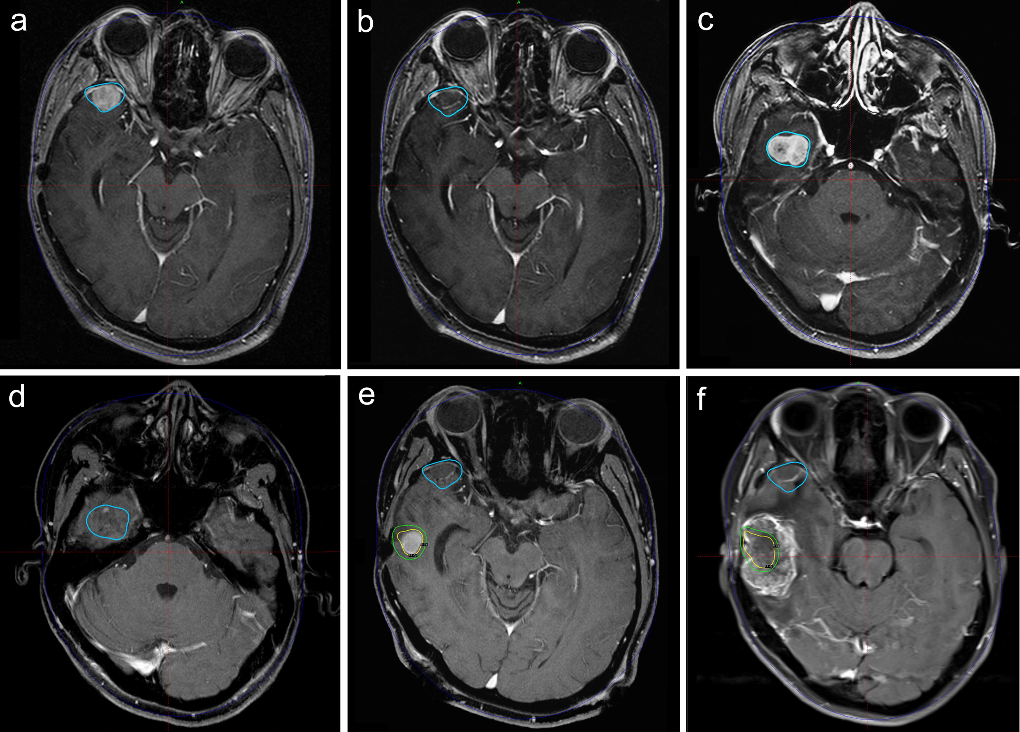 This figure illustrates a patient who had previously undergone two resections and one EBRT before undergoing GKRS for two recurrences.