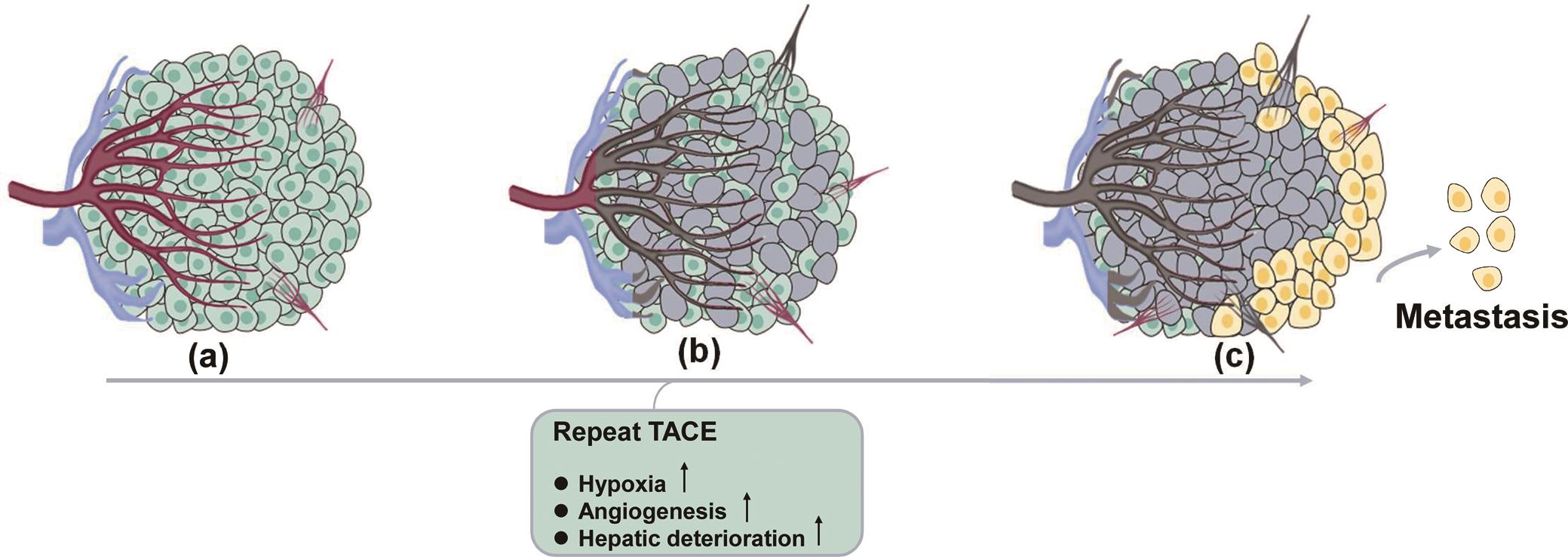 Pathological and physiological changes in HCCs with consecutive insufficient responses to TACE.