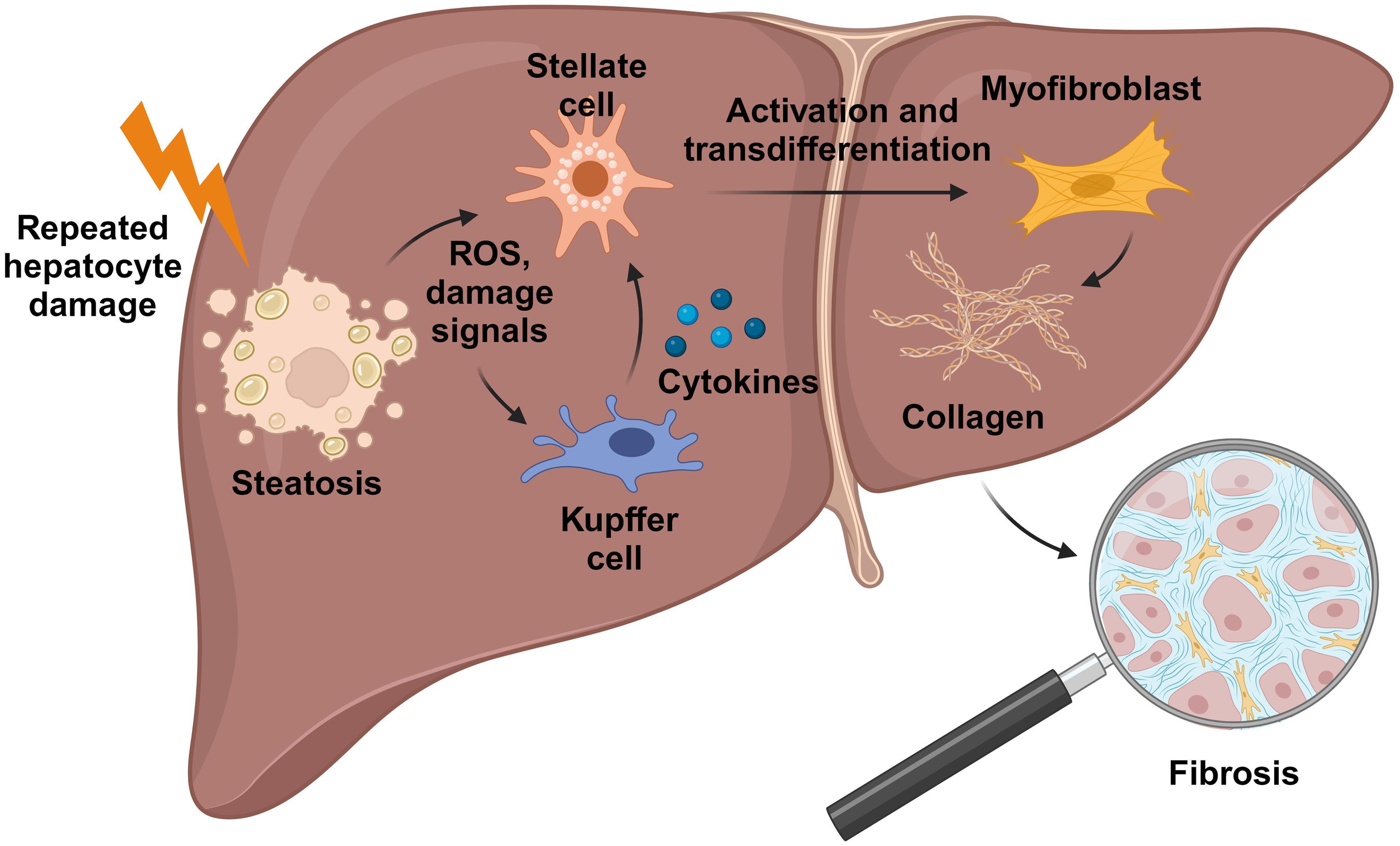 Schematic overview of the development of liver fibrosis in MASLD.