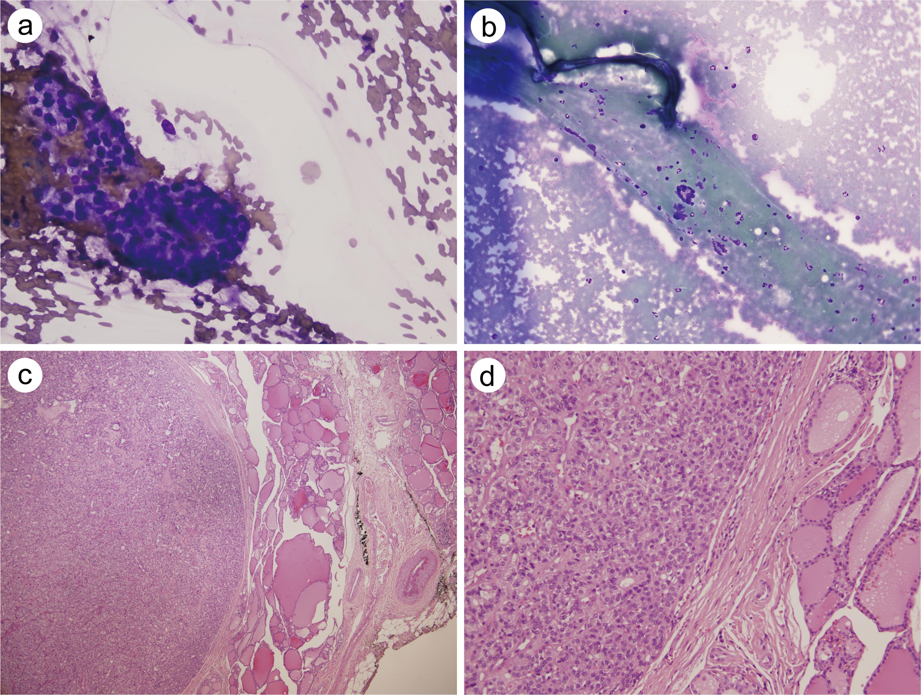 FNAC of a patient diagnosed with AUS via repeat cytology who underwent surgery and was diagnosed with a follicular adenoma.