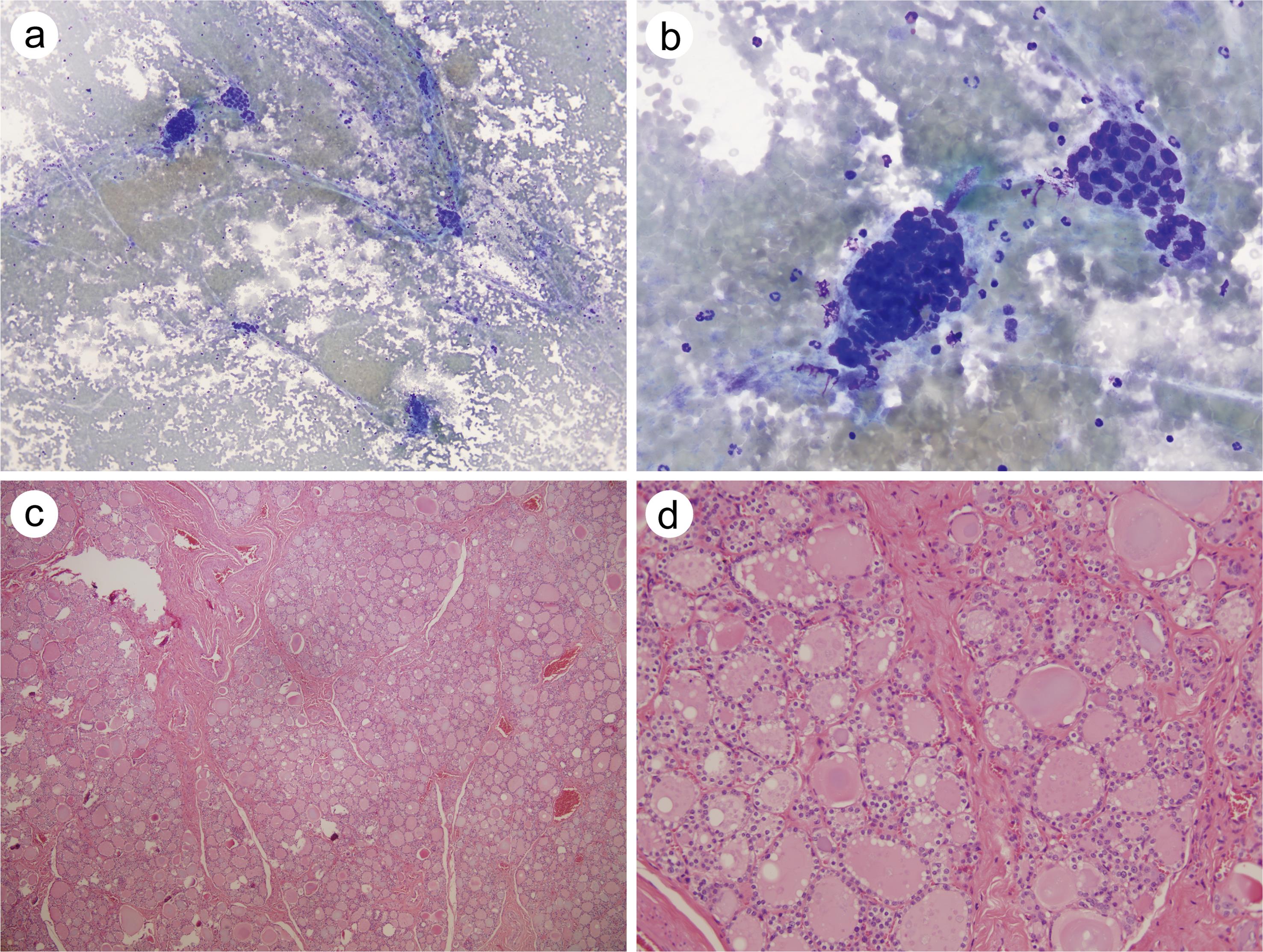 FNAC of a patient diagnosed with AUS via repeat cytology who underwent surgery and was diagnosed with hyperplastic changes.