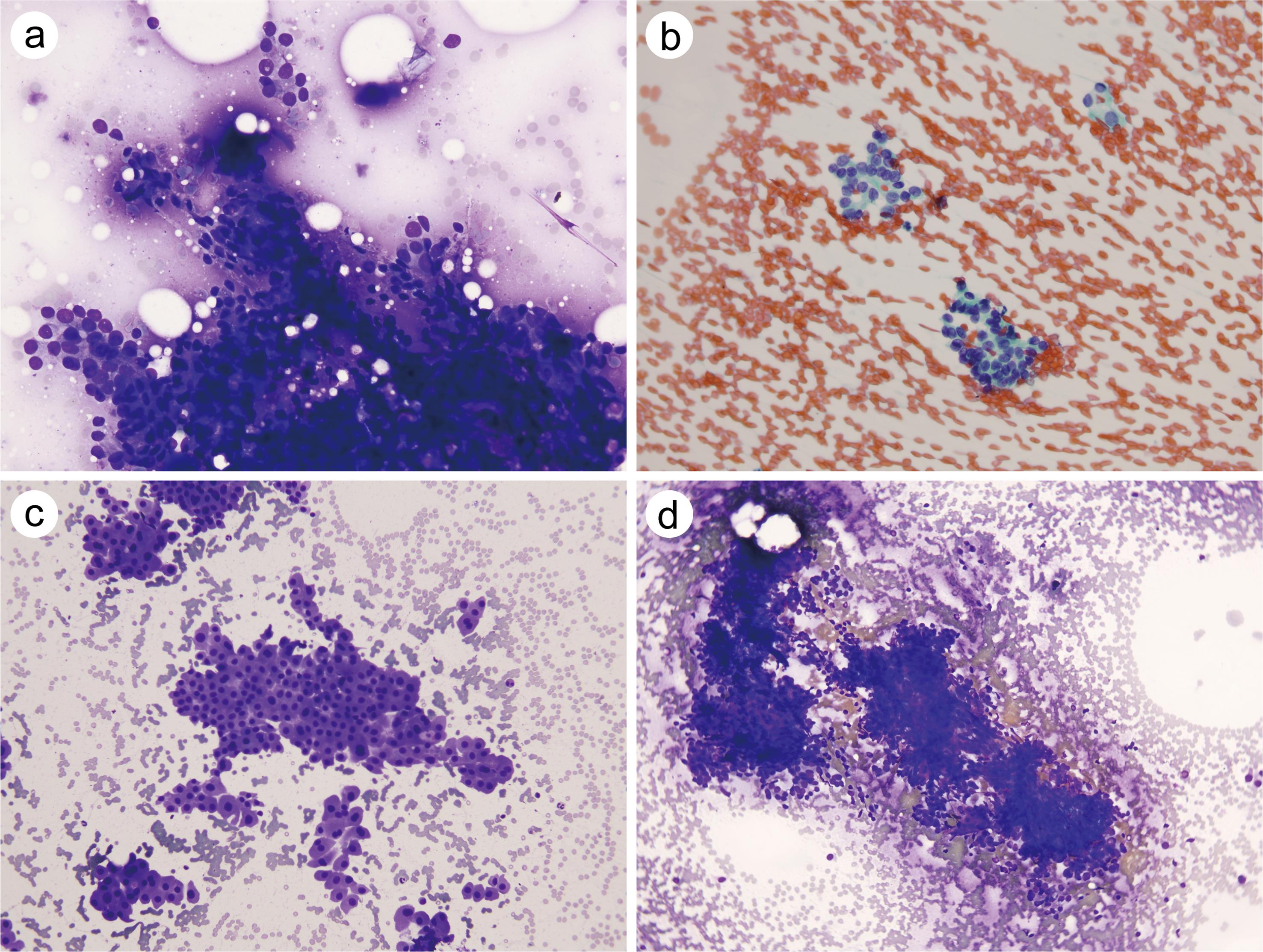 Main morphological changes leading to the diagnosis of AUS.