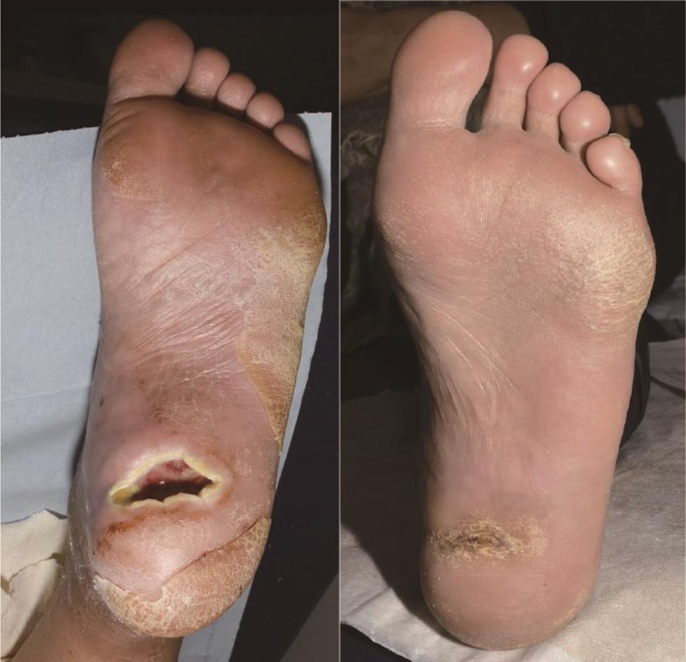 Hindfoot ulcer: Pre-treatment and post-treatment at 13 weeks.