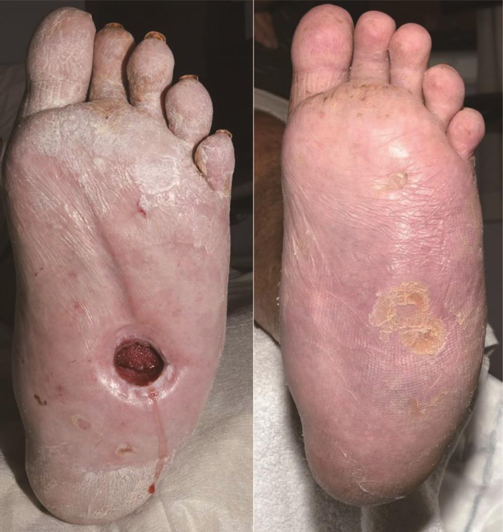 Midfoot ulcer before and after treatment for 10 weeks.