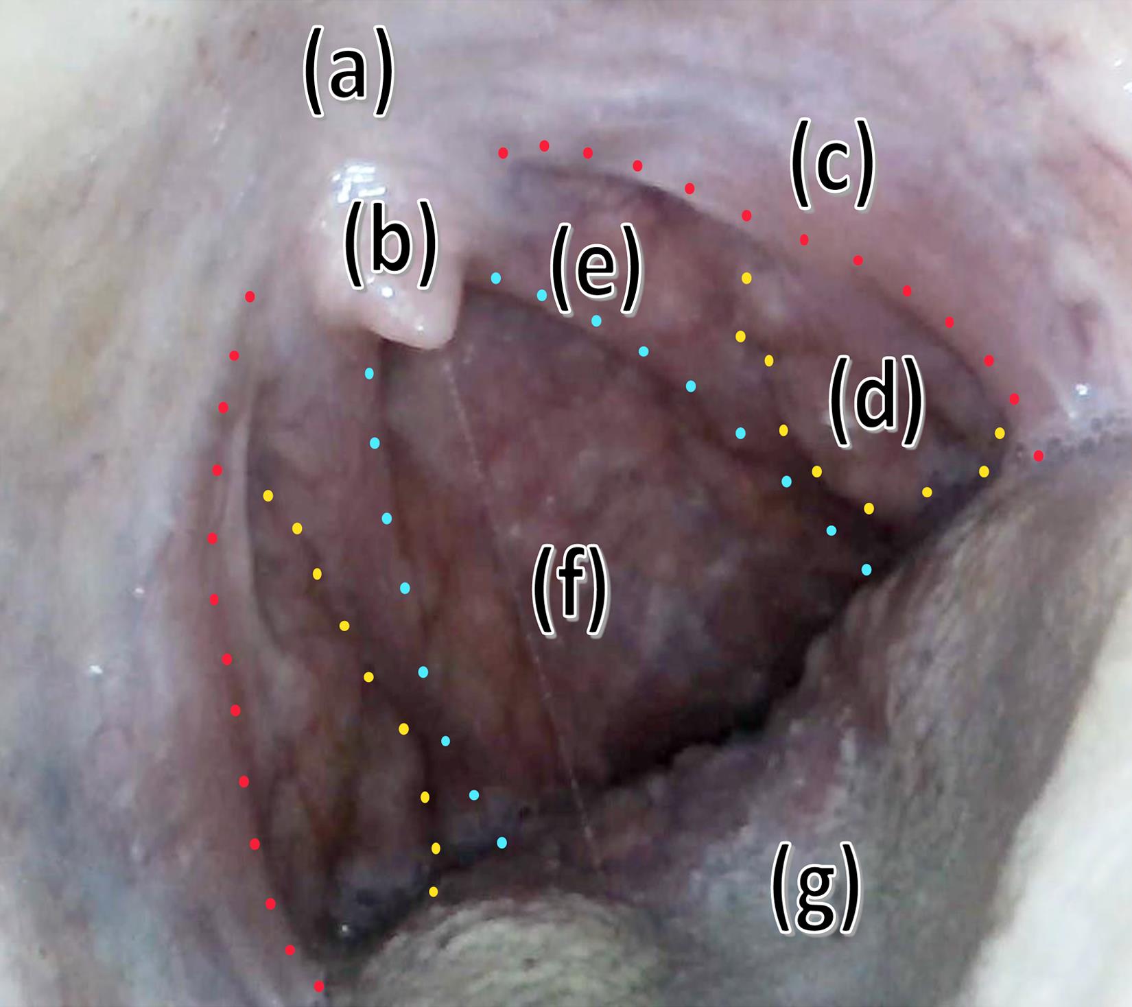 Still image from a video of the oropharynx.