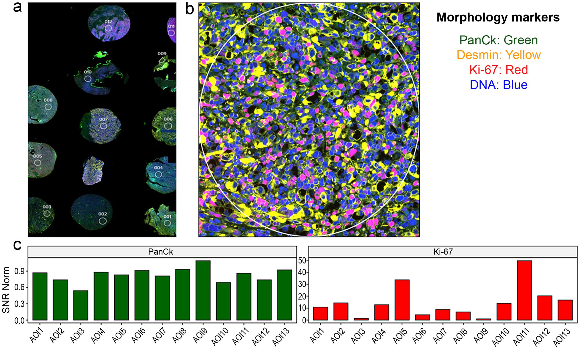 Multiplex immunofluorescence/immunohistochemistry exhibits significant potential in co-localizing protein targets and selecting regions of interest for further Digital spatial profiling (DSP) analysis.