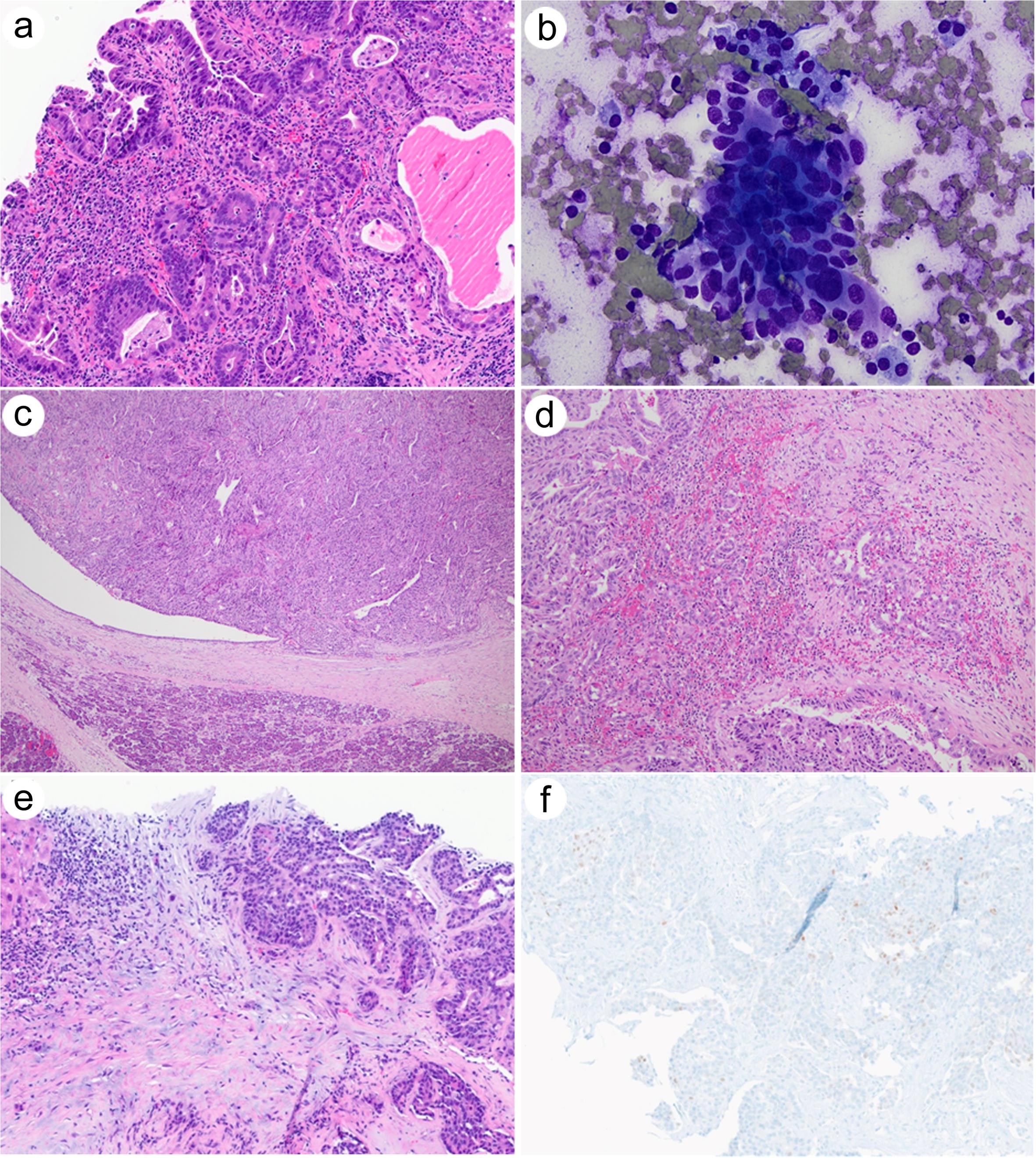 Histologic findings of the esophageal adenocarcinoma, pancreatic lesion in cytology, resection specimens and liver lesion.