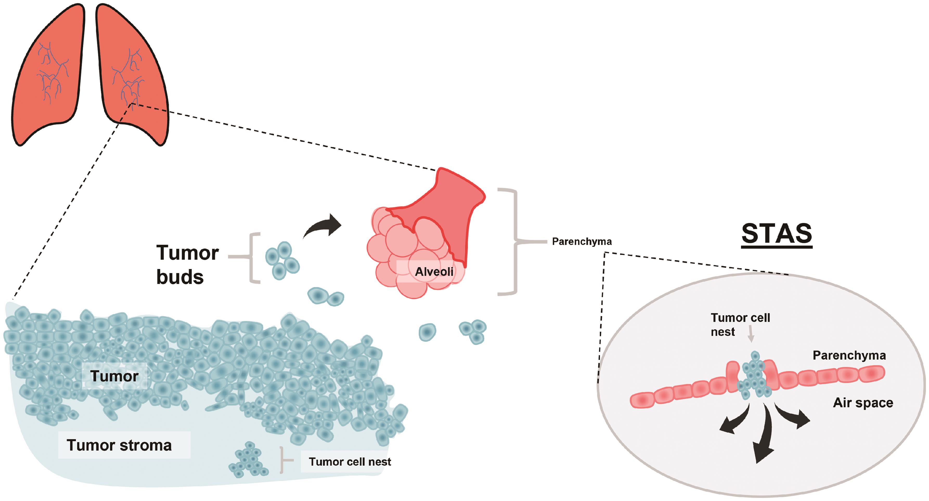 The relationship among tumors, tumor budding, tumor spread through air spaces, and tumor cell nests.