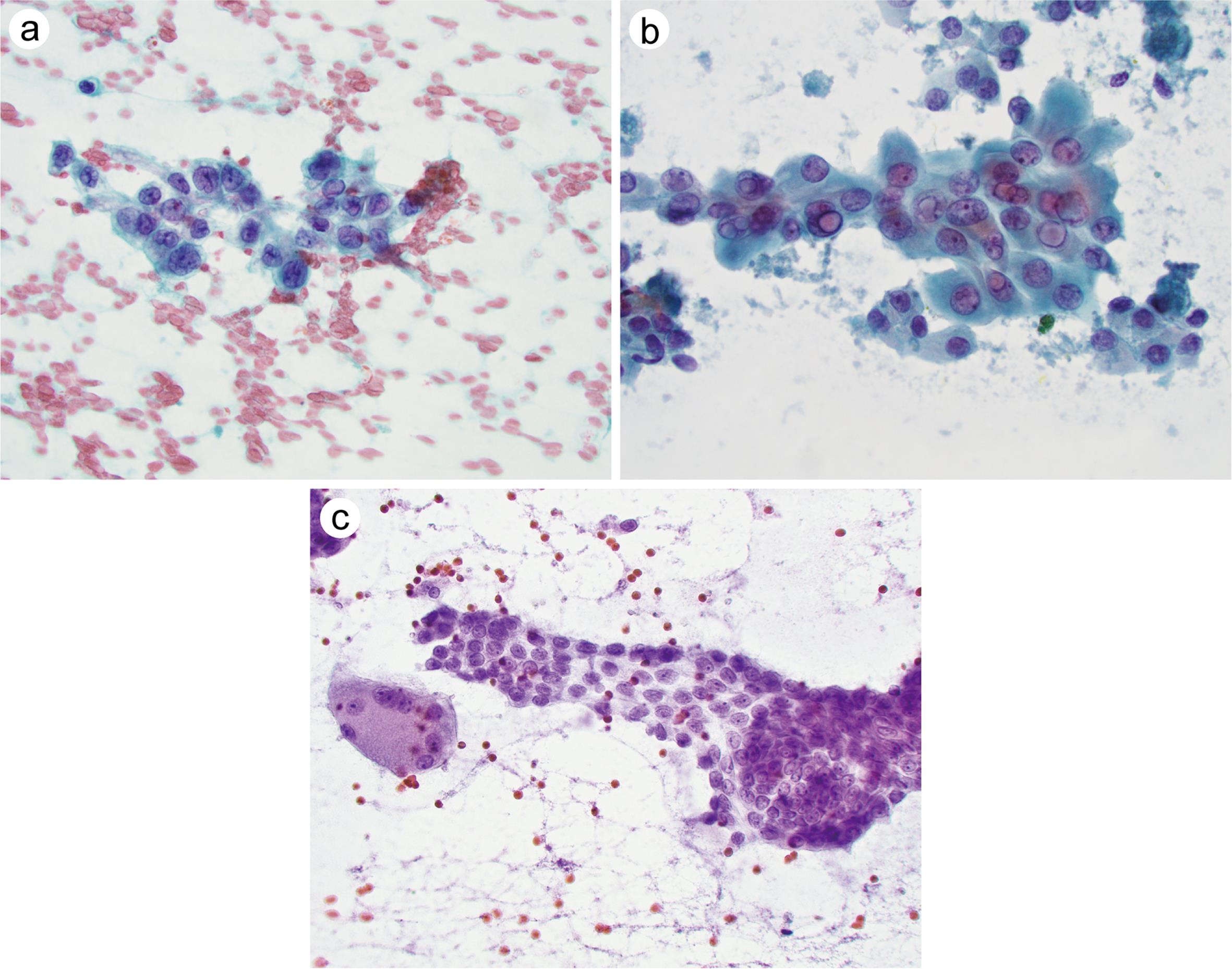 Nuclear features of papillary thyroid carcinoma (PTC).