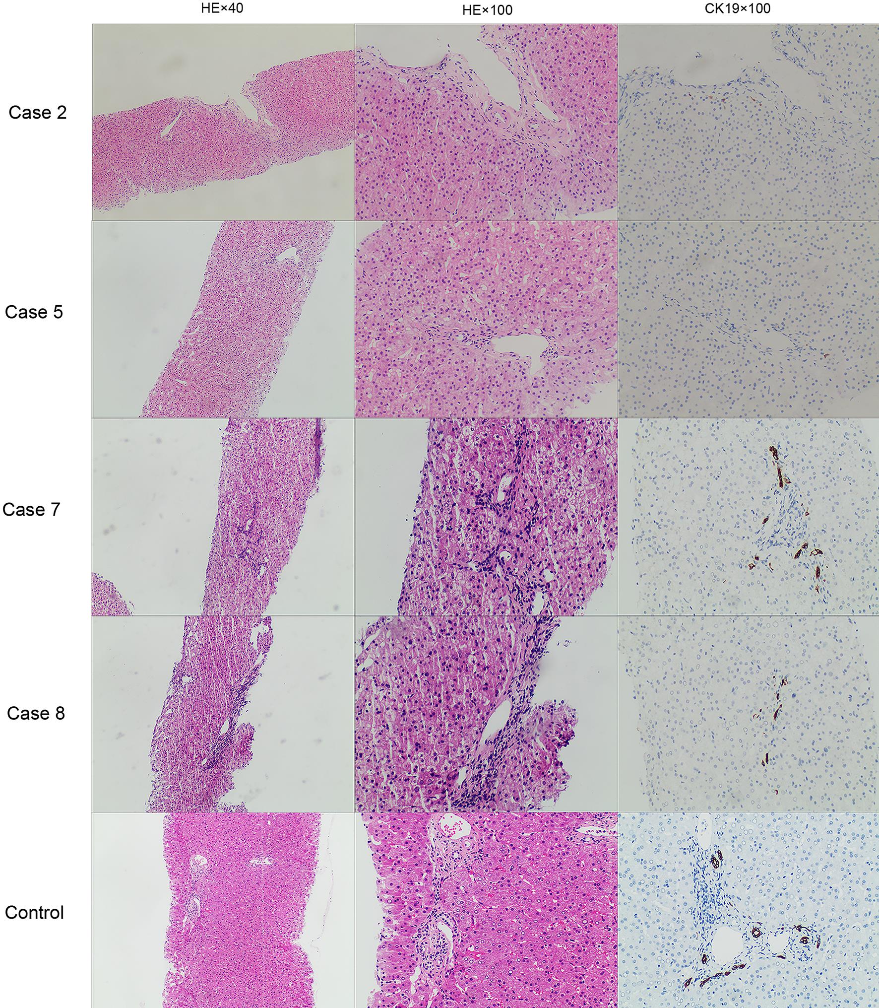 Liver biopsies of four patients with Alagille syndrome (AGS).