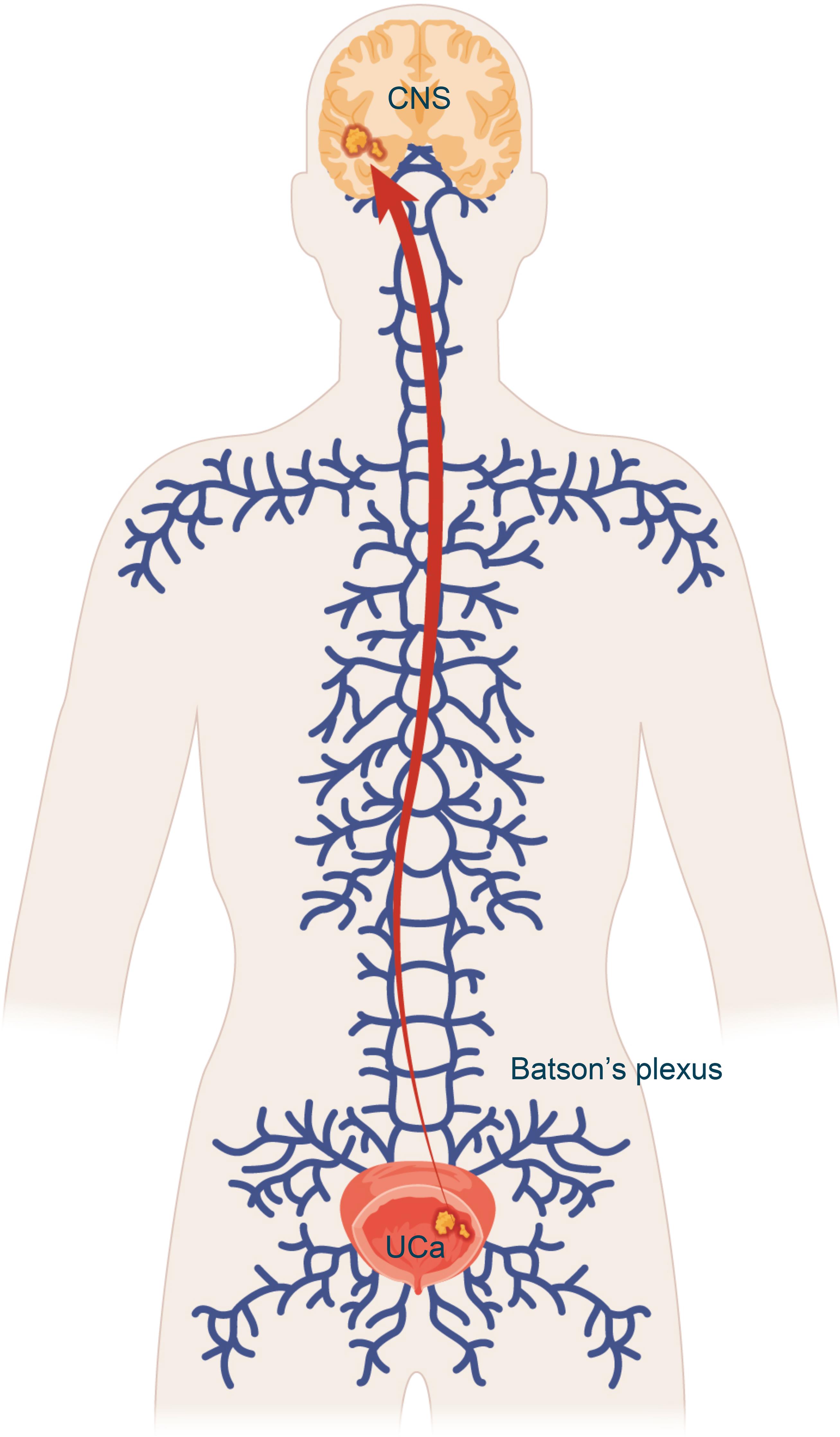 Illustration depicting Batson’s plexus as a possible route for hematogenous spreading of UCa to the CNS.