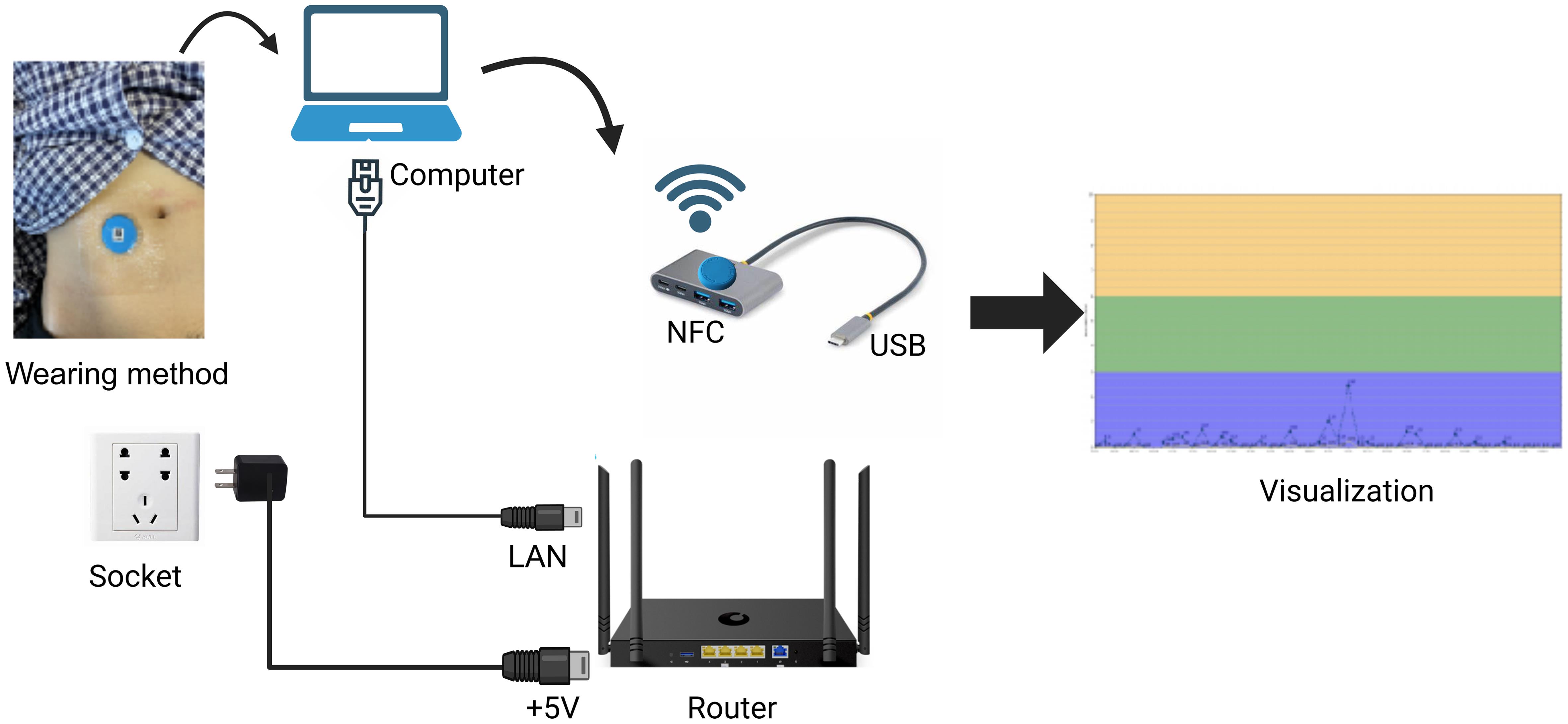 Acquisition of bowel sound data signals by continuous auscultation recorder.