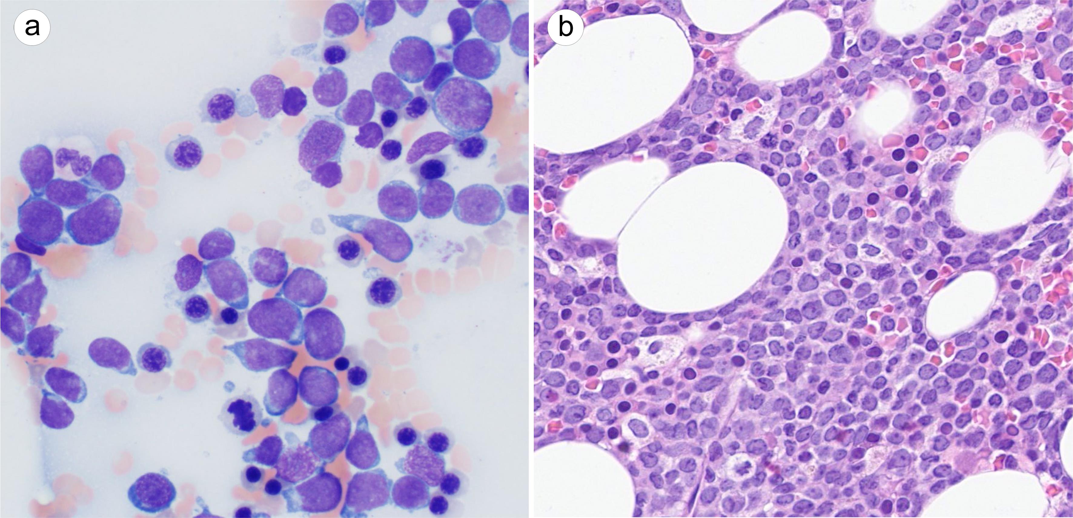 Numerous blasts in the bone marrow aspirate smear (a, Giemsa, 1,000×) and biopsy (b, H&E, 400×) from the current presentation.
