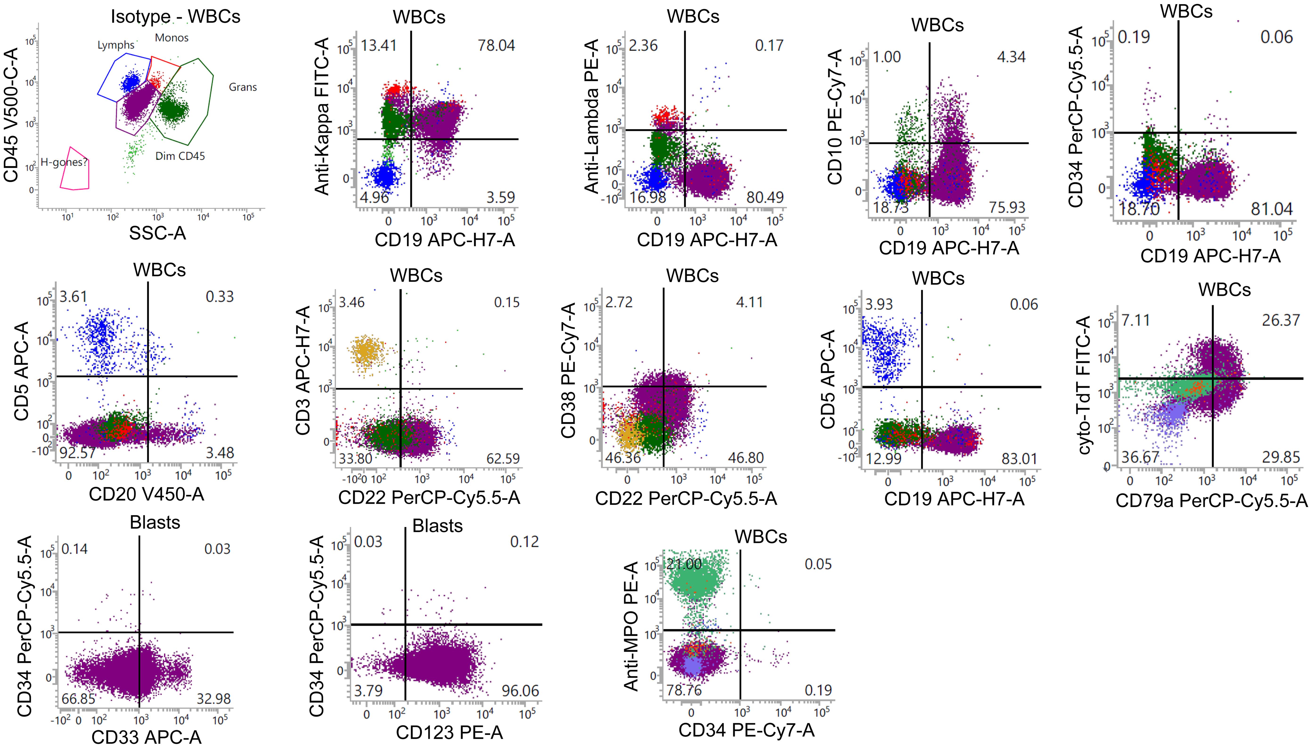Unusual surface light chain expression in the B-lymphoblasts detected by flow cytometric analysis.