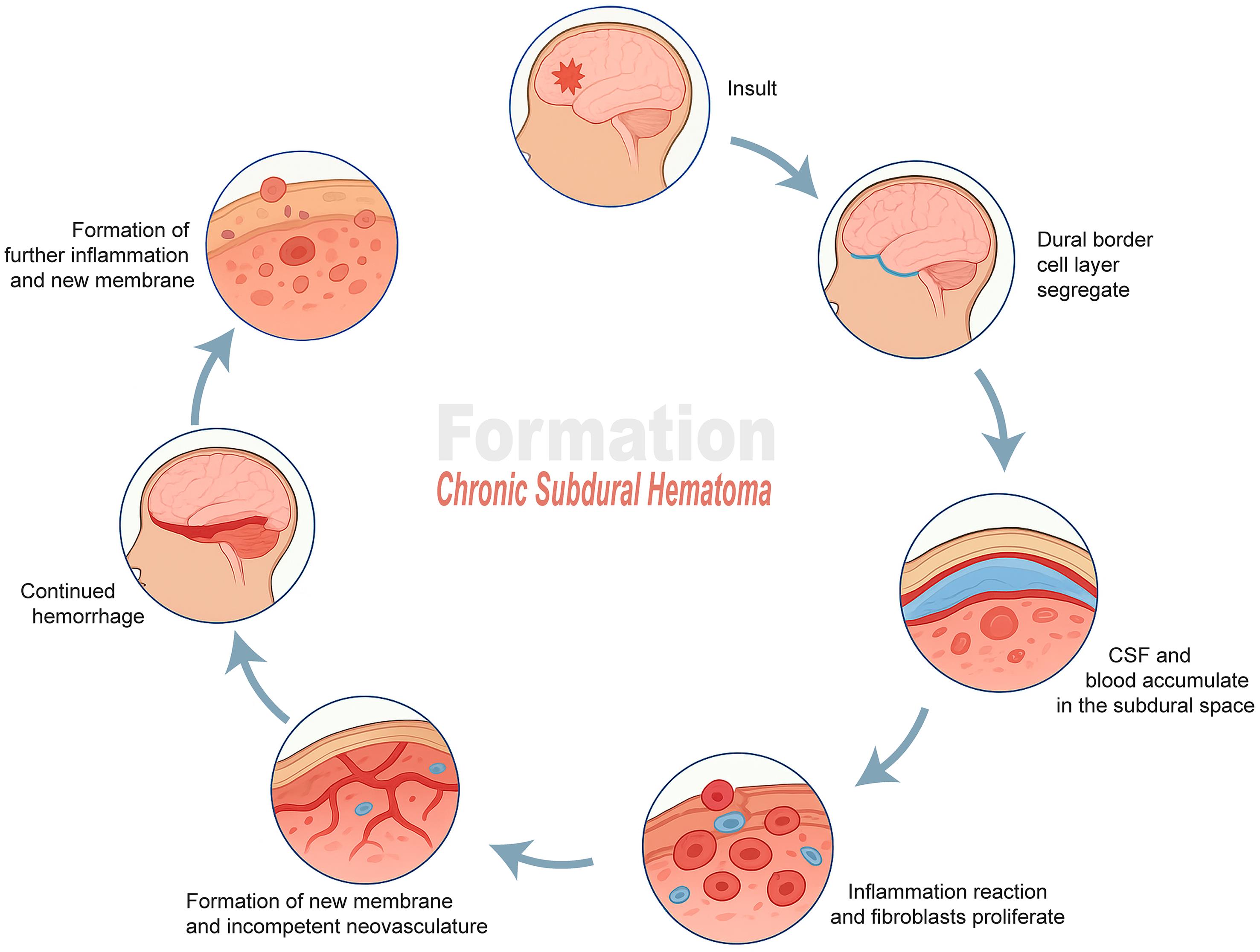 Pathophysiology of chronic subdural hematoma formation.