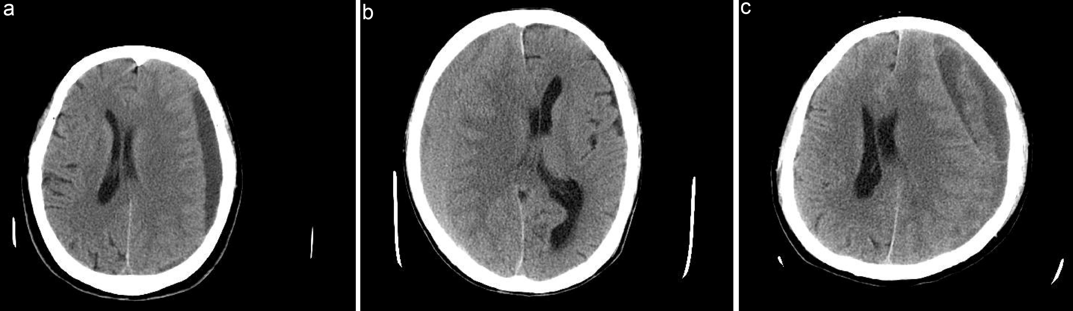 Computed tomography images of chronic subdural hematoma.