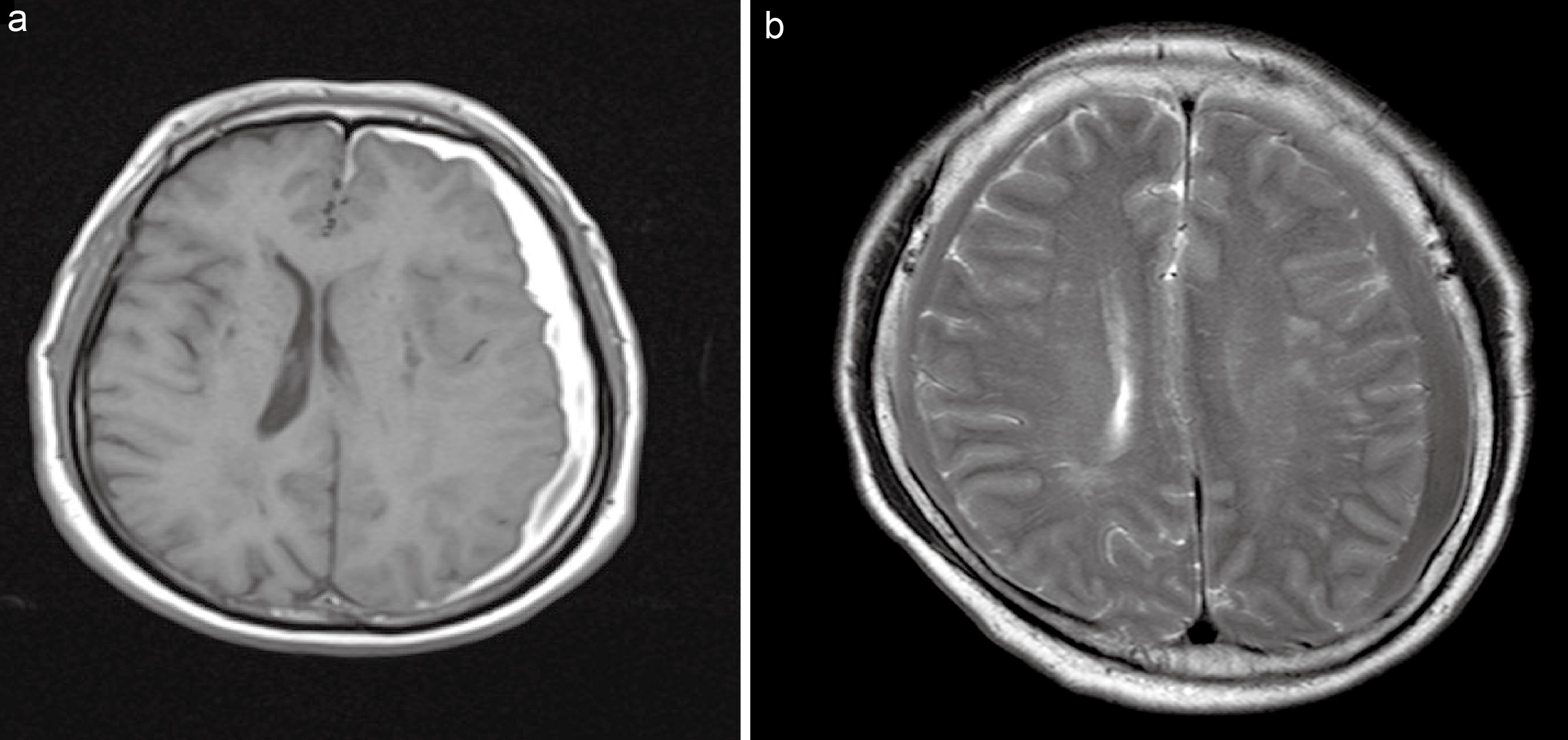 Magnetic resonance images of chronic subdural hematoma.