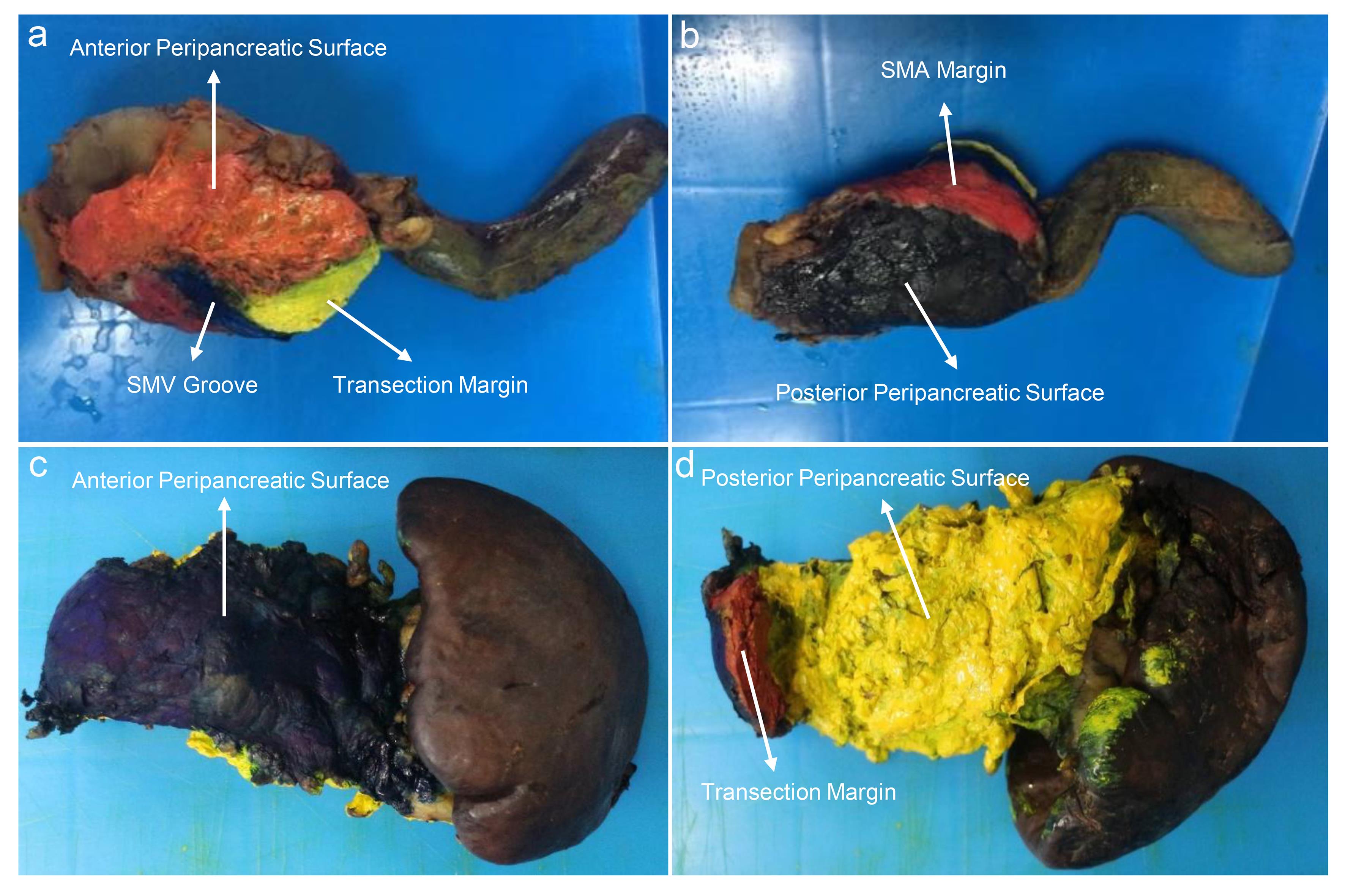 Resection margins and specimen surfaces of pancreaticoduodenectomy and distal pancreatectomy specimens with color inking.