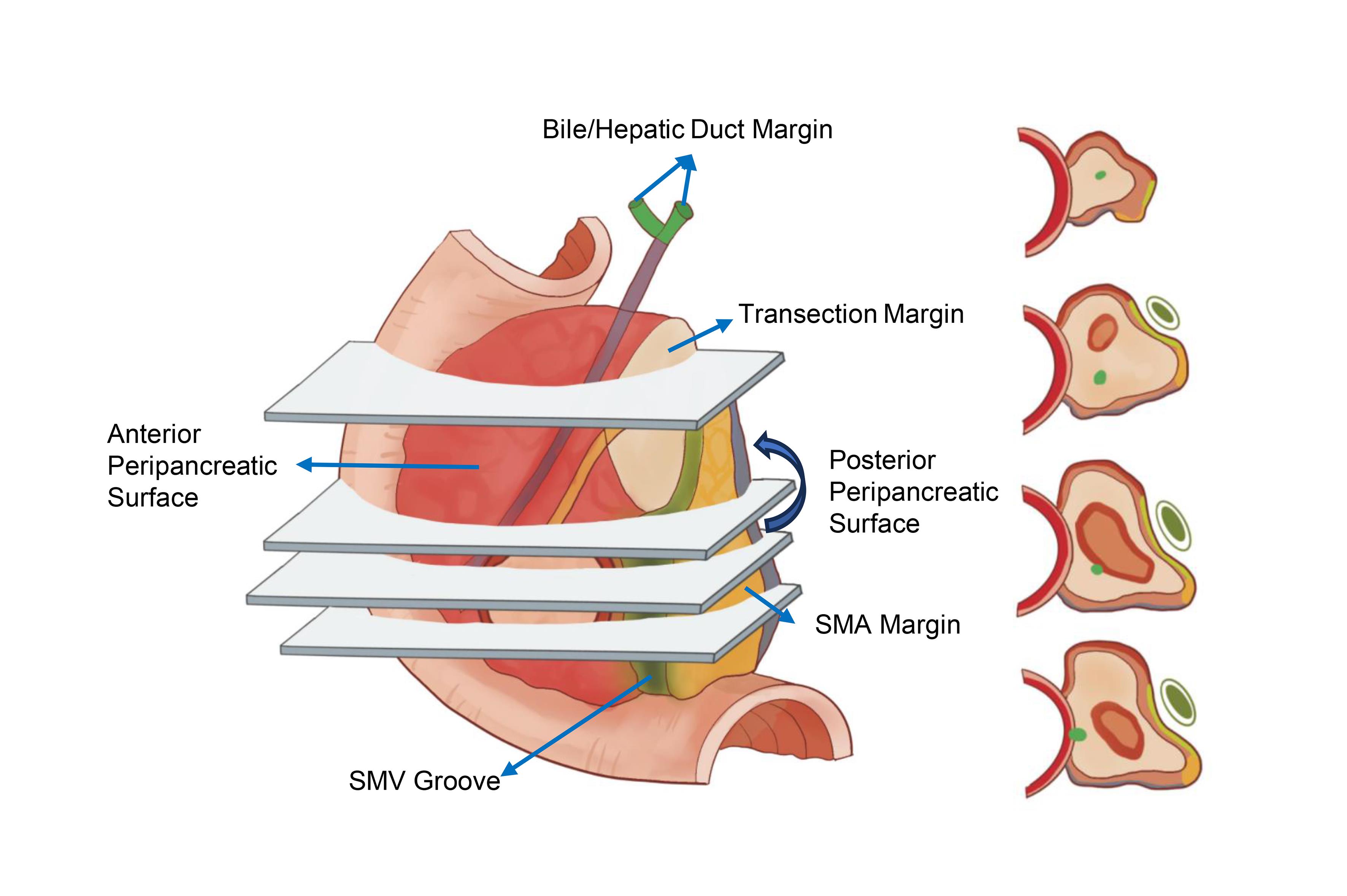 Schematic diagram of the sectioning protocol for a pancreaticoduodenectomy specimen.