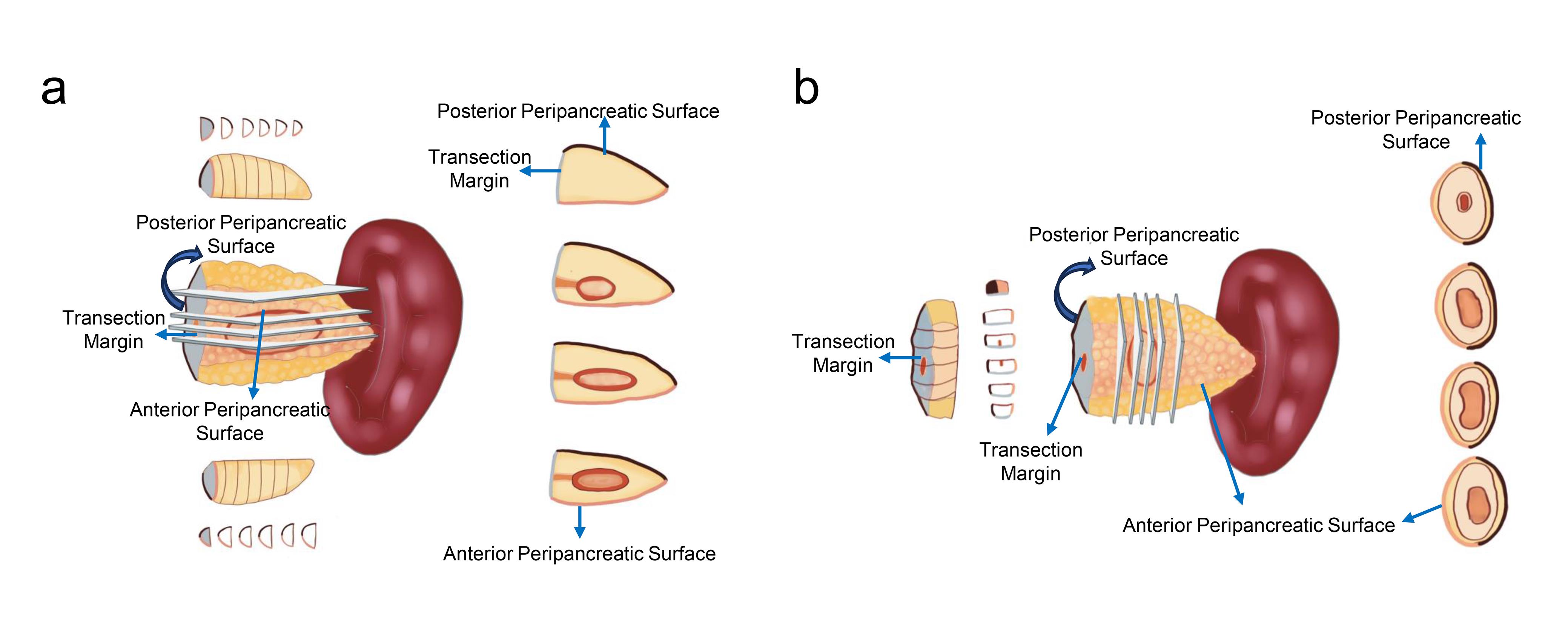 Schematic diagram of sectioning protocols for distal pancreatectomy specimens.