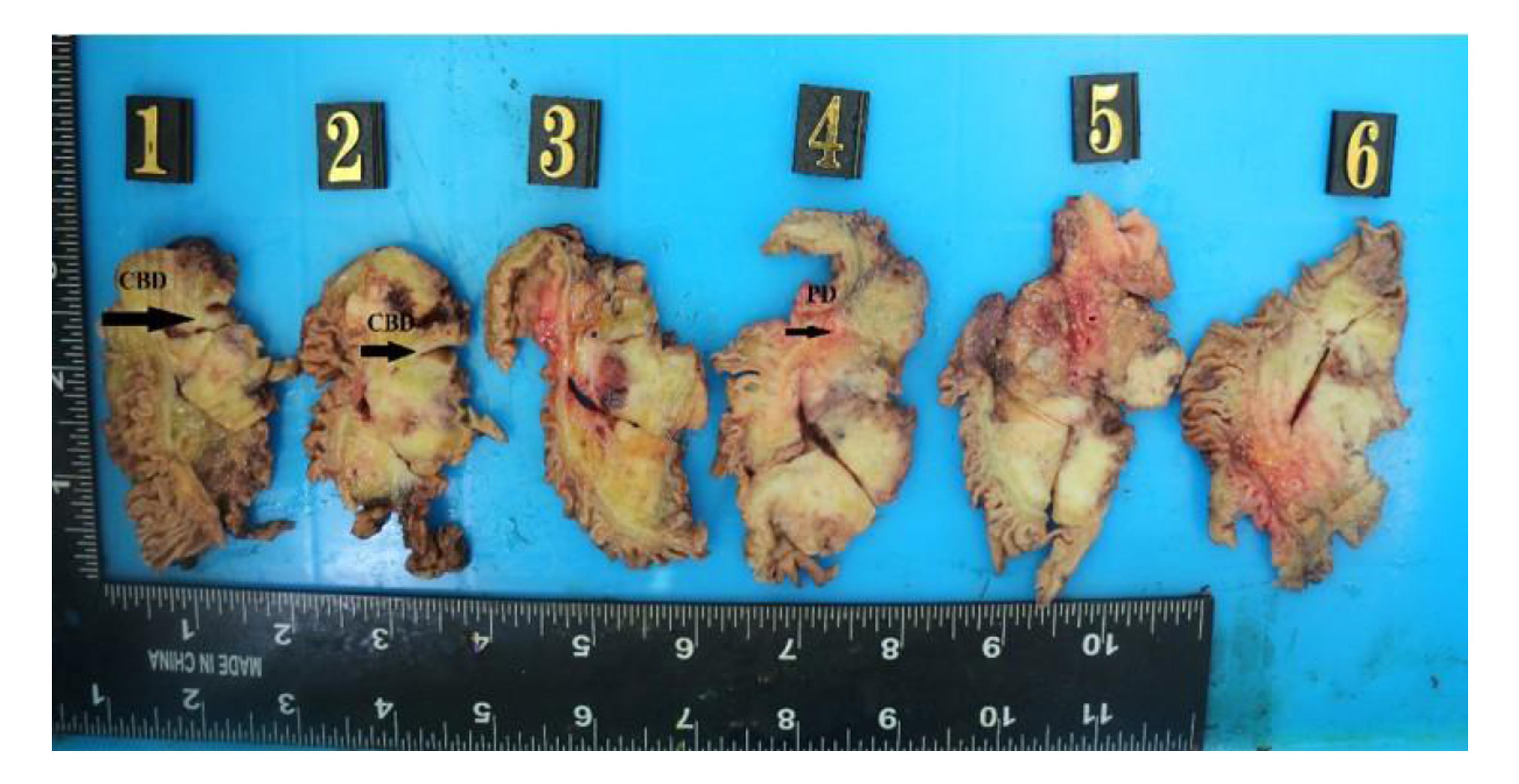 Photo documentation of serial sections of a pancreatic gross specimen.