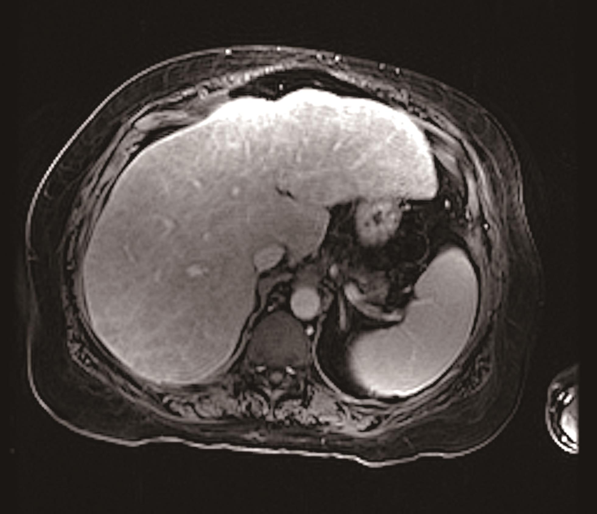Contrast-enhanced arterial phase MRI of the liver demonstrating moderate heterogeneity (score of 3).