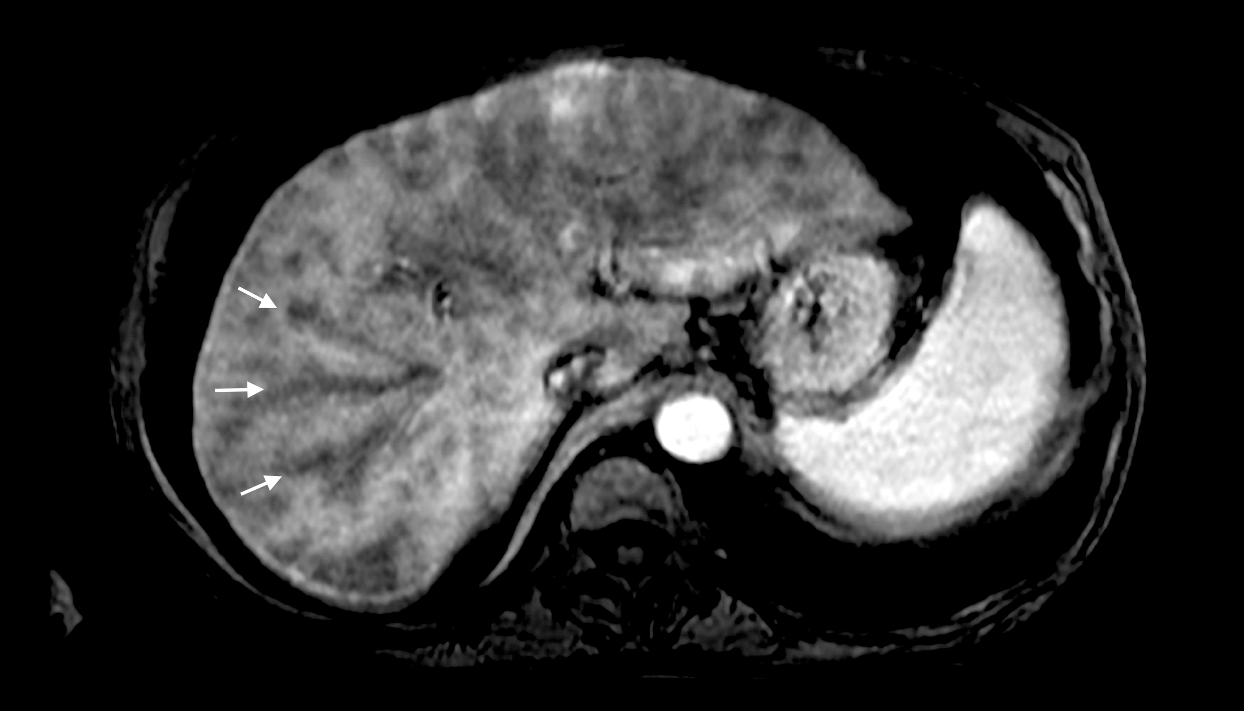 Contrast-enhanced arterial phase MRI of the liver demonstrating perivascular branching pattern (score of 5) identified by white arrow.