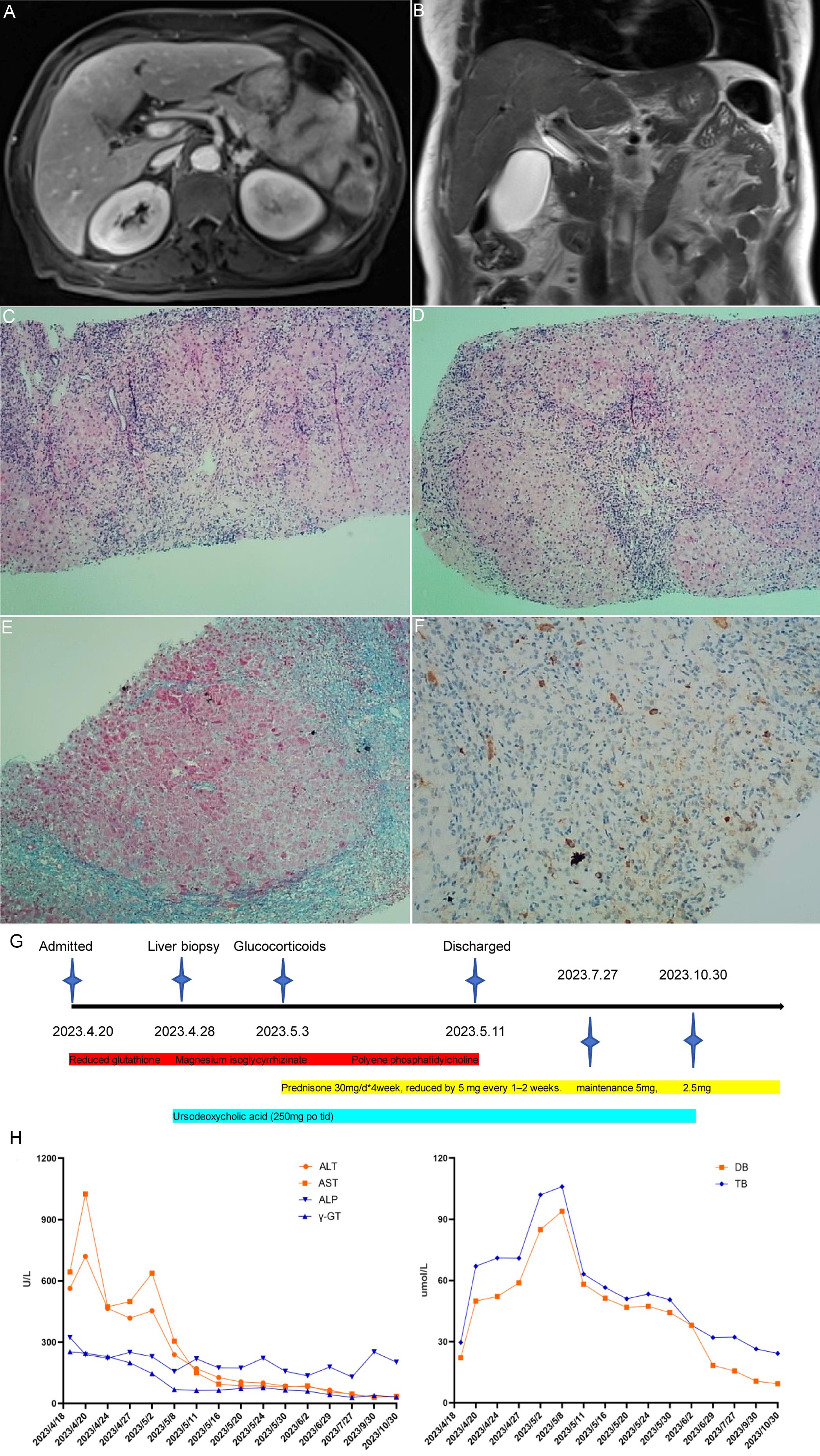 MRI, histopathology, clinical diagnosis-treatment course, and lab parameter dynamic changes of the patient with IgG4-related AIH.