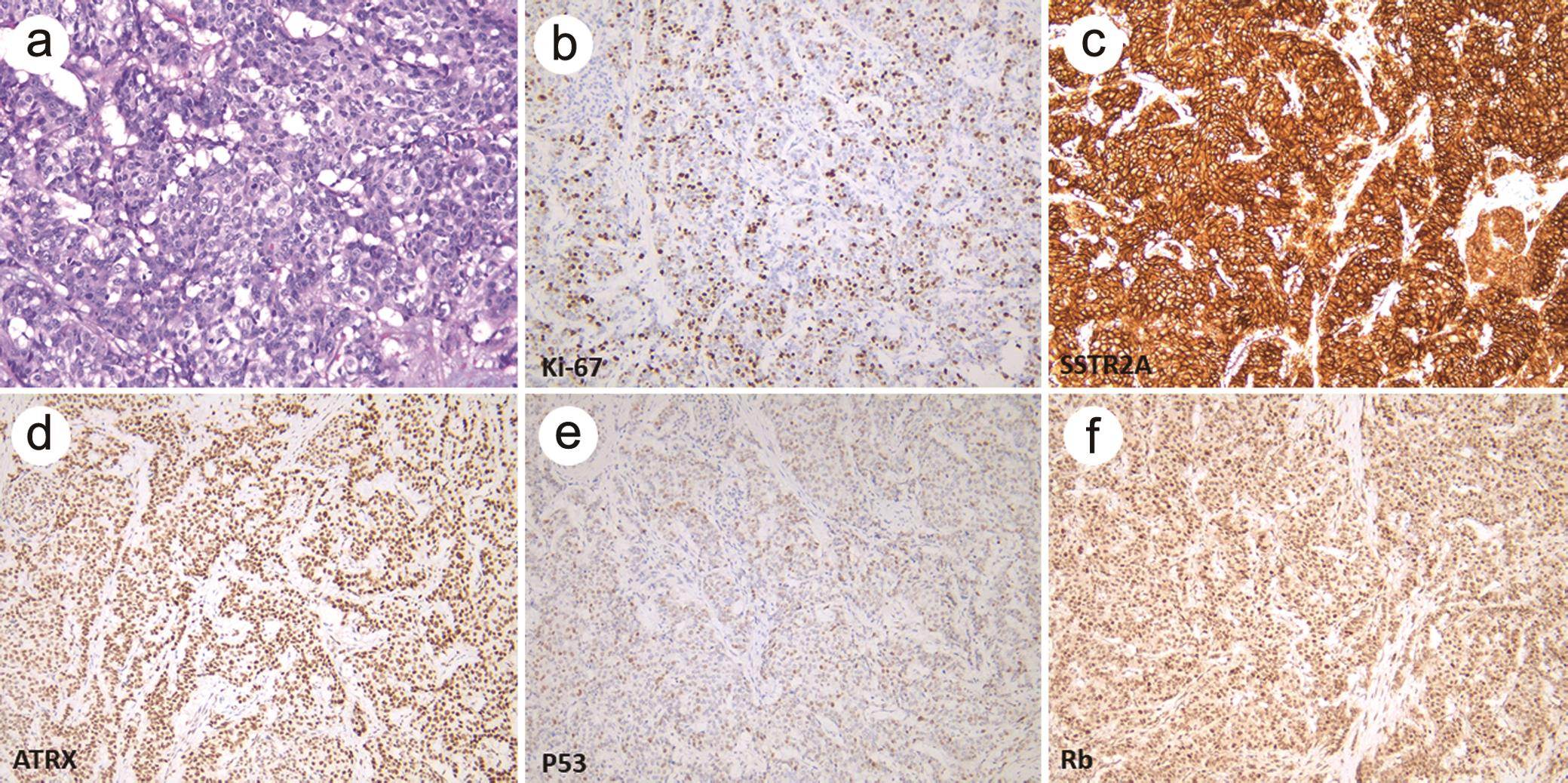 High-grade (G3), well-differentiated pancreatic neuroendocrine tumor.