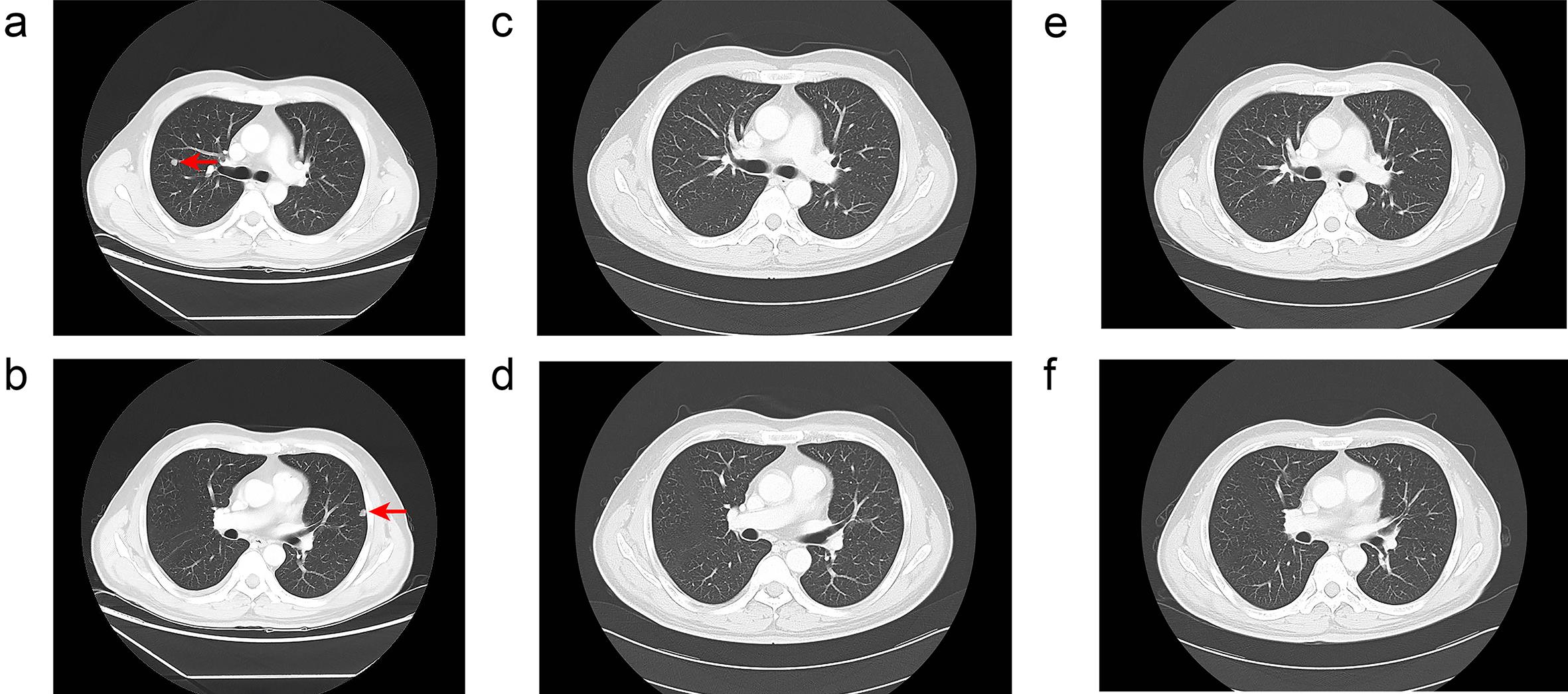 Computed tomography images of the lung showing pulmonary metastases at different time points.