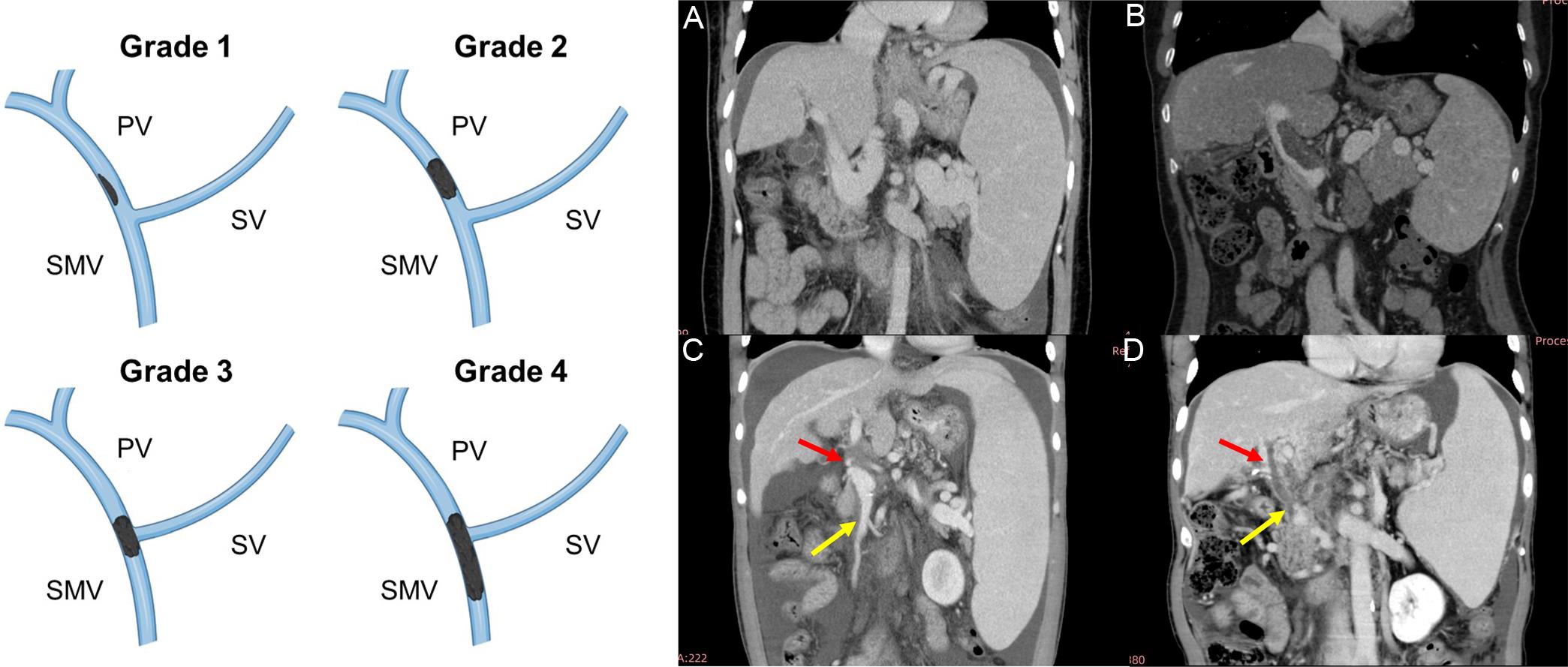 Yerdel classification of portal vein thrombosis.