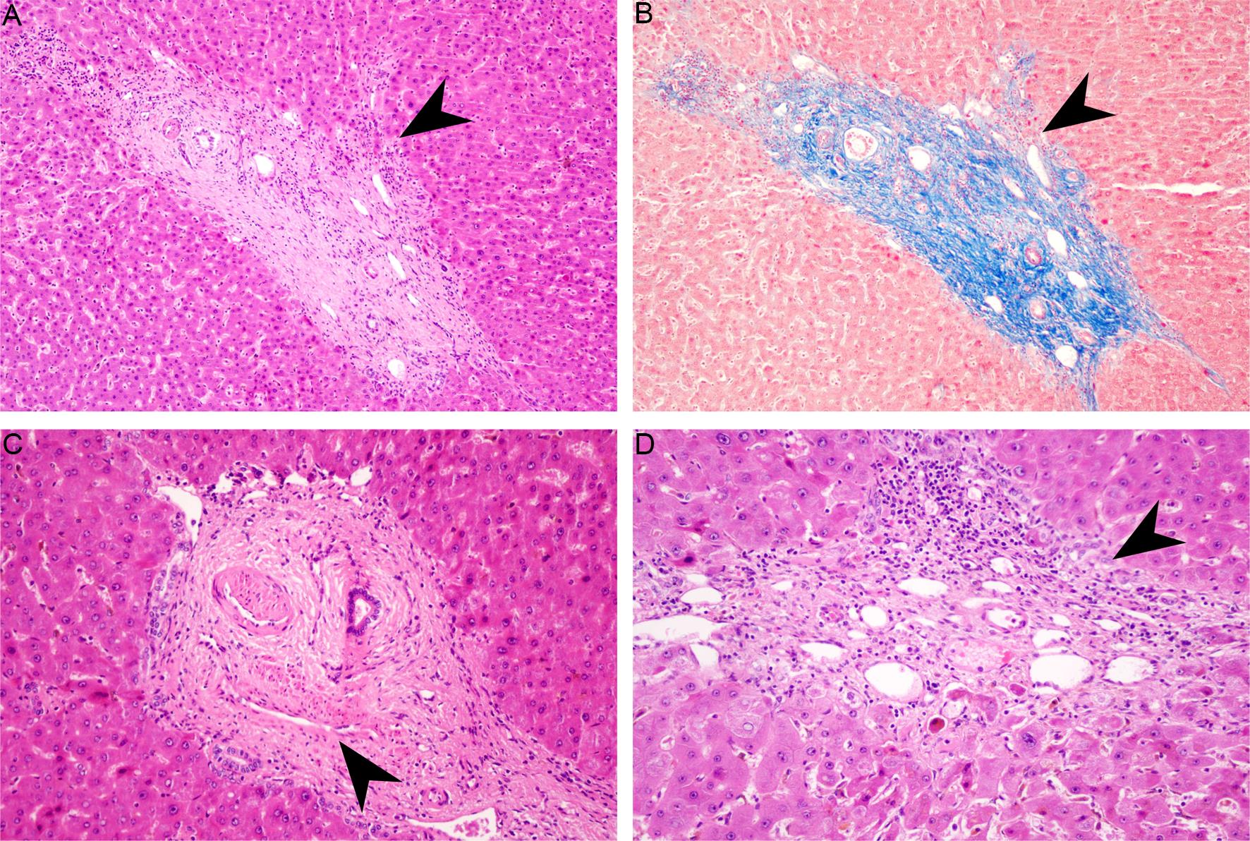 Representative histological features of a 56-year-old female PSVD patient with PVT.