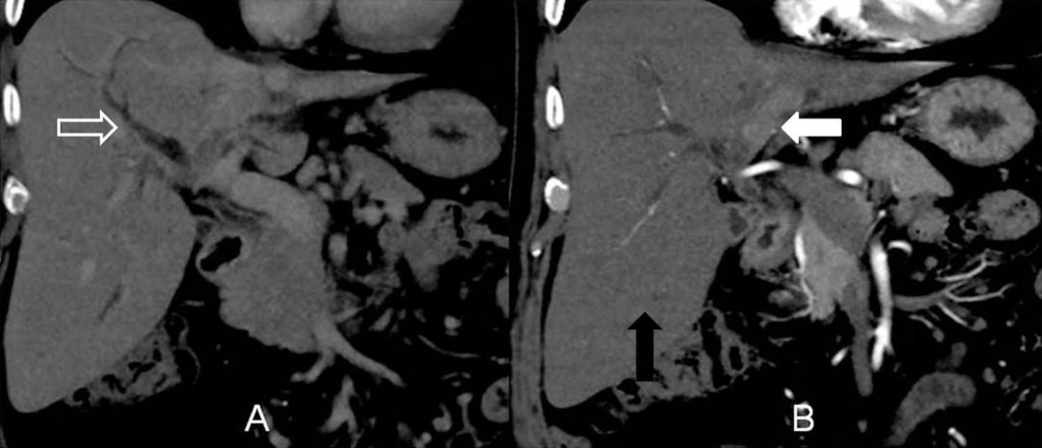 Portal venous phase images showing dilatation of right-sided intrahepatic bile ducts (hollow white arrow), atrophy of left hemiliver and hypertrophy of right hemiliver (solid black arrow).