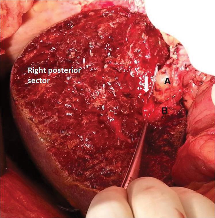 Intraoperative photograph taken after complete resection shows the bile duct of the liver remnant with a feeding tube put through the PTBD tract (solid white arrow), main portal vein (A), and right hepatic artery (B).