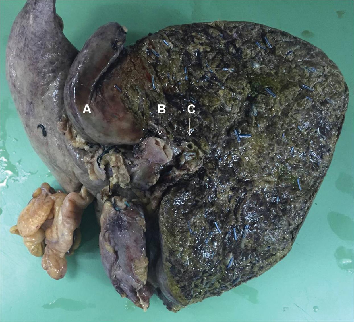 Photograph of resected specimen showing the caudate lobe (A), distal bile duct (B) and right posterior sectoral duct margin (C).