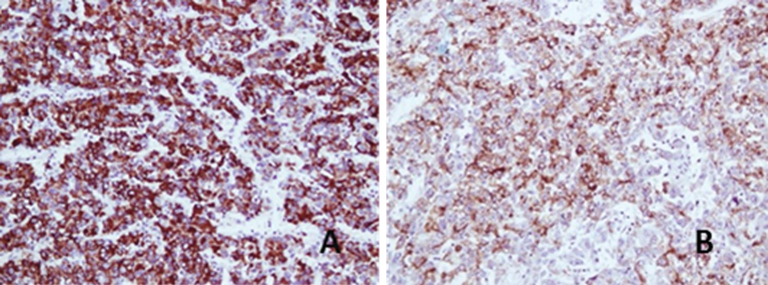 Immunohistochemistry showing a strong and diffuse cytoplasmic positivity with Hep Par 1 (A) and Glypican 3 (B), 200X.