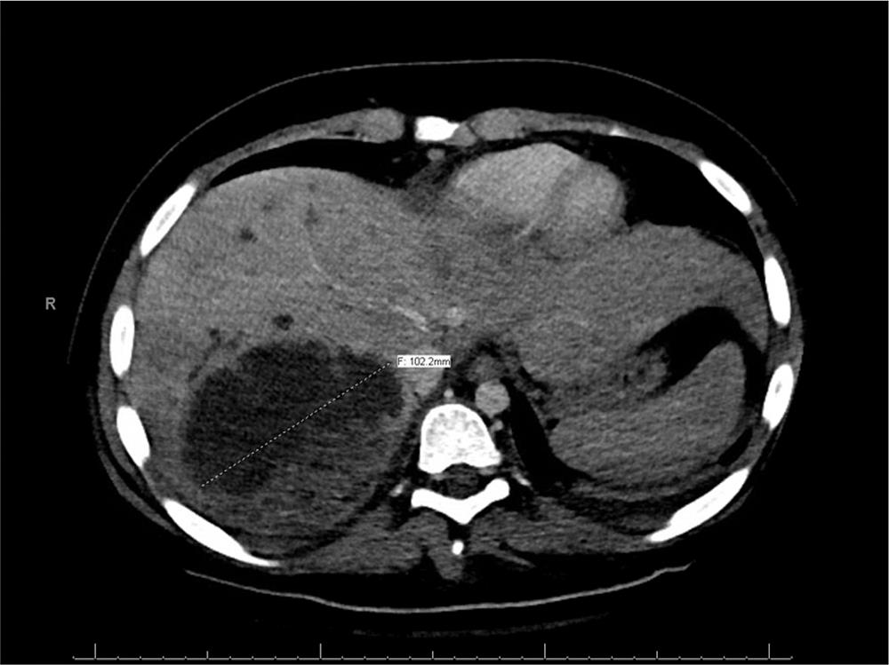 Computed tomography (CT) of the abdomen with contrast done on admission.