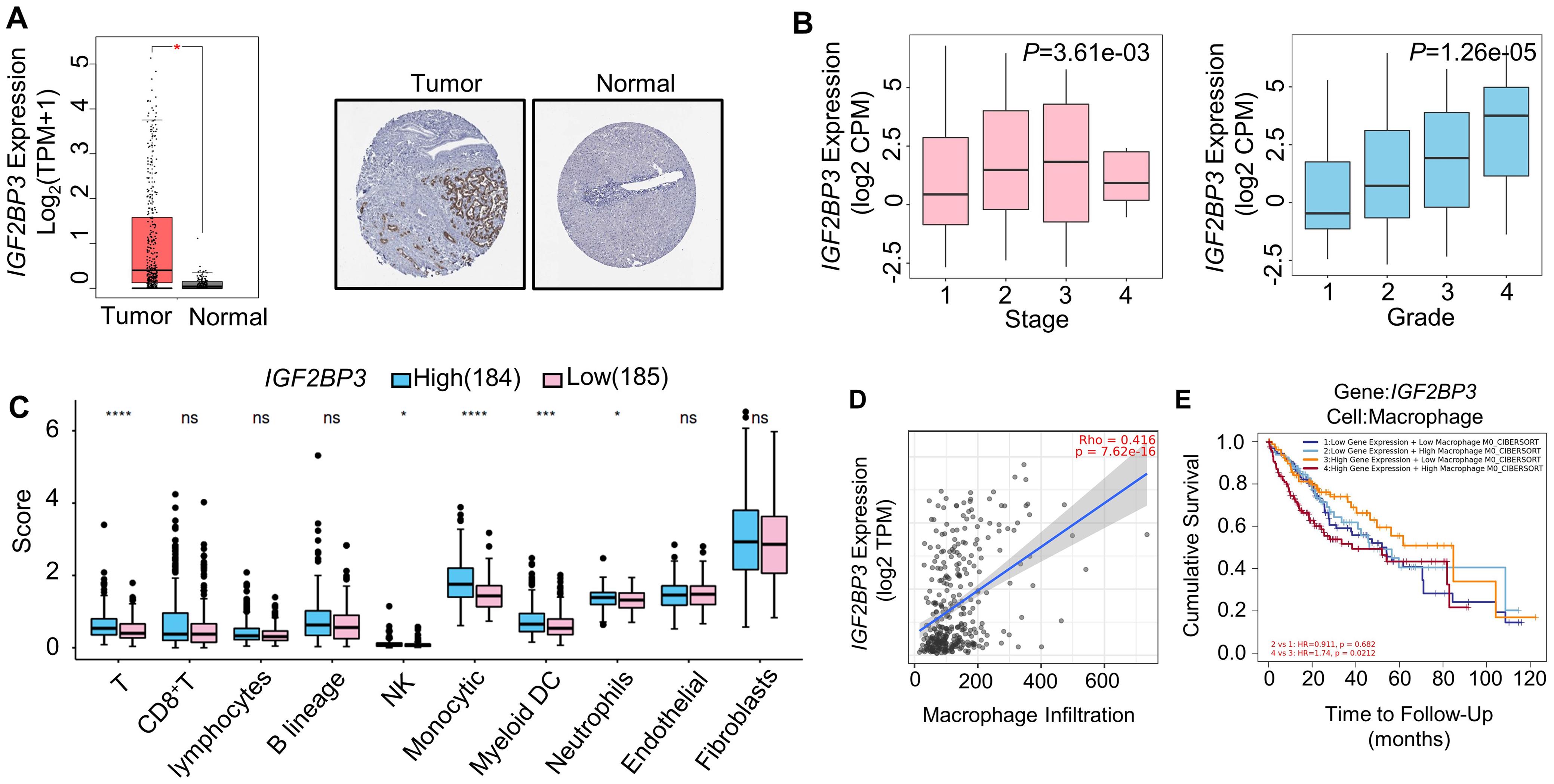 Expression of IGF2BP3 is increased in HCC and is positively correlated with the infiltration of macrophages.
