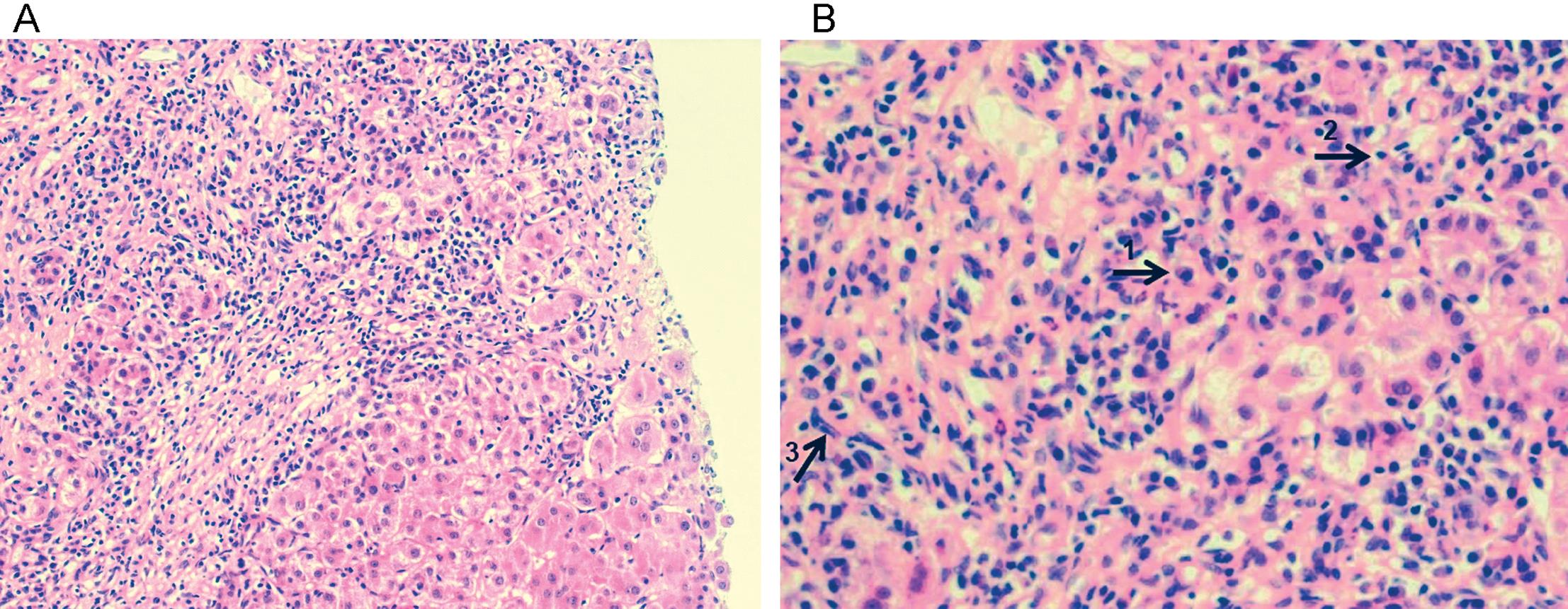 Histological picture of AIH. (A) Portal and peri-portal inflammatory infiltrate, characteristic of autoimmune hepatitis, consists of (B) plasma cells, lymphocytes and monocytes/macrophages, as phenotypically indicated by arrows labeled 1, 2, and 3, respectively. There is evidence of interface hepatitis and piecemeal necrosis of hepatocytes. Hematoxylin and eosin staining, magnification ×200 (A) and x400 (B). (Credit: Dr Alberto Quaglia)