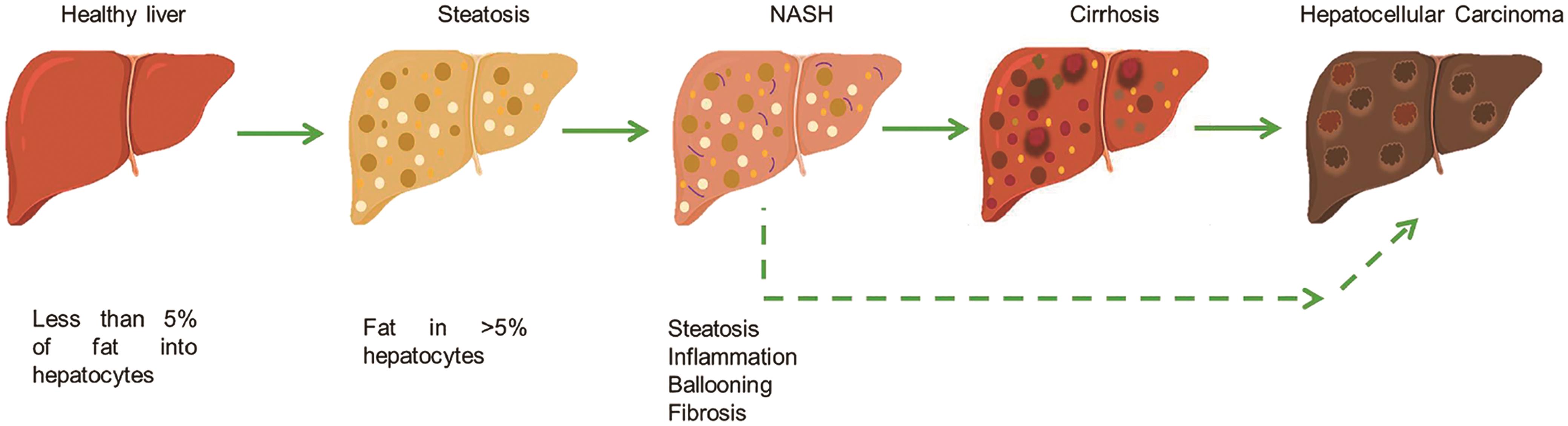Spectrum of non-alcoholic fatty liver disease (NAFLD).