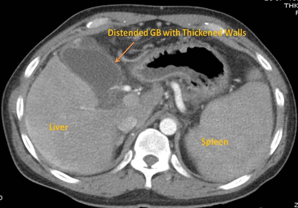Abdominal computed tomography sagittal section in the arterial phase, made 2 days prior to drainage and showing thickened gall bladder and shrunken liver.