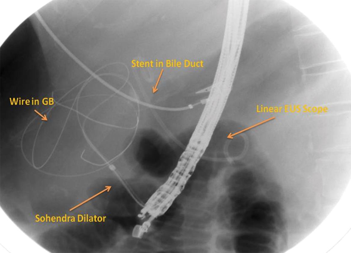Fluoroscopy image made during the procedure and showing dilatation of the tract achieved by a Sohendra biliary dilator over a radio opaque guidewire coiled in gall bladder and a stent in the bile duct.