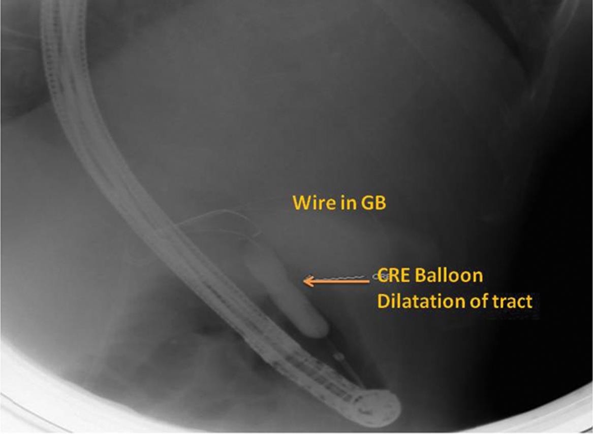 Fluoroscopy image made during the procedure and showing the dilatation of the tract using a controlled radio expansion balloon over a radio opaque guidewire placed in the gall bladder.