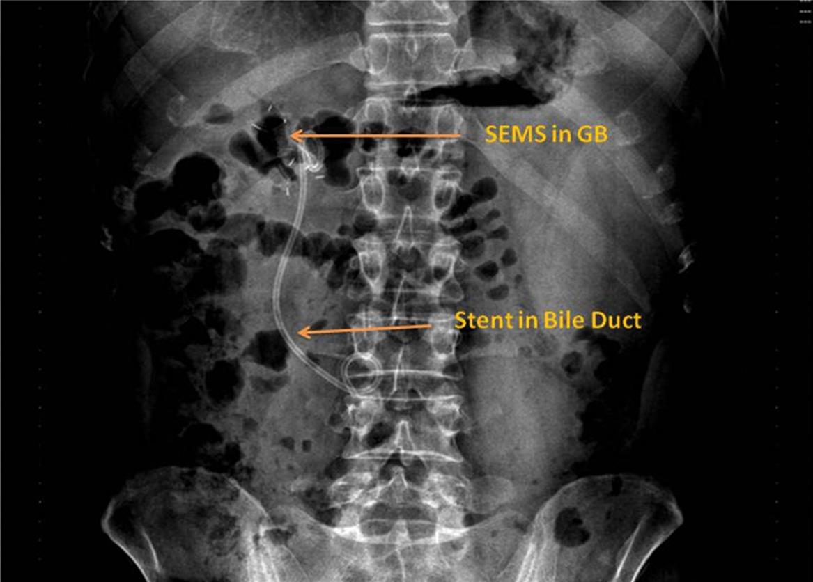 Abdominal X-ray showing a self-expanding metal stent (Nagi stent) in the gall bladder and a plastic double-pigtail stent in the bile duct, made 2 days post-procedure.