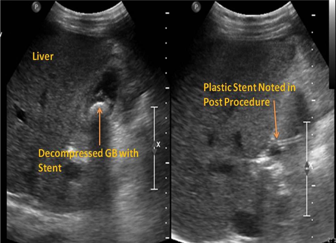 Abdominal ultrasound made 2 days post-procedure shows a decompressed gall bladder with stent inside (Left) and the plastic stent entering into the gall bladder (Right).
